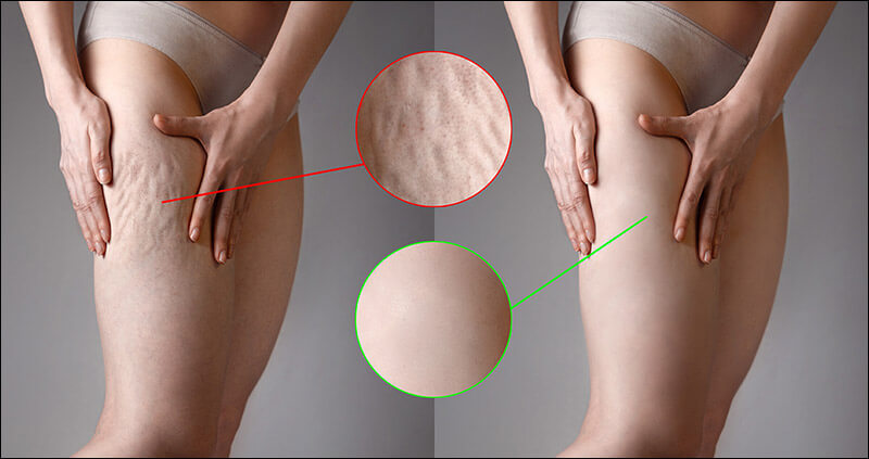 Cellulite is a complex multifactorial process what are the options