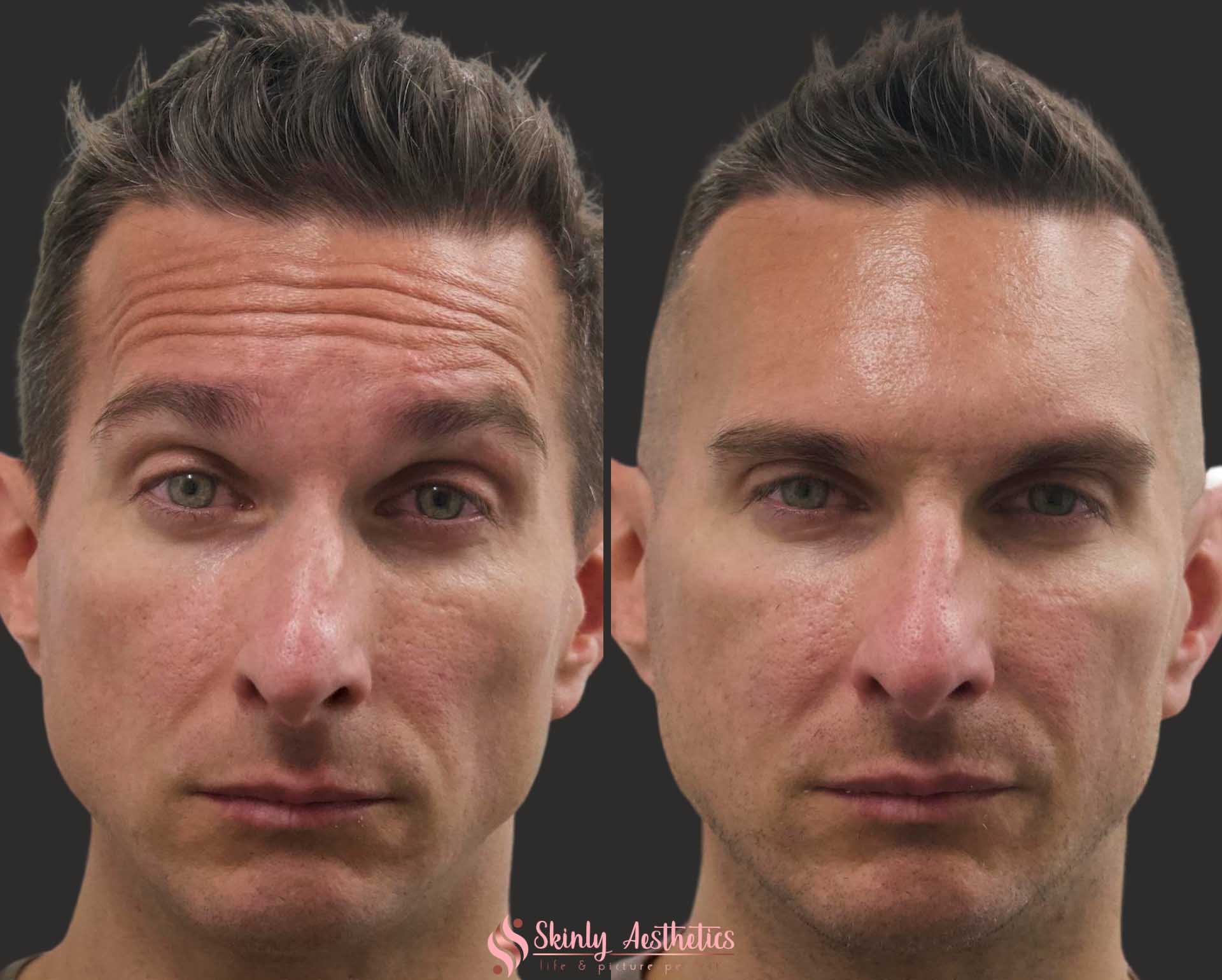Botox forehead wrinkles male