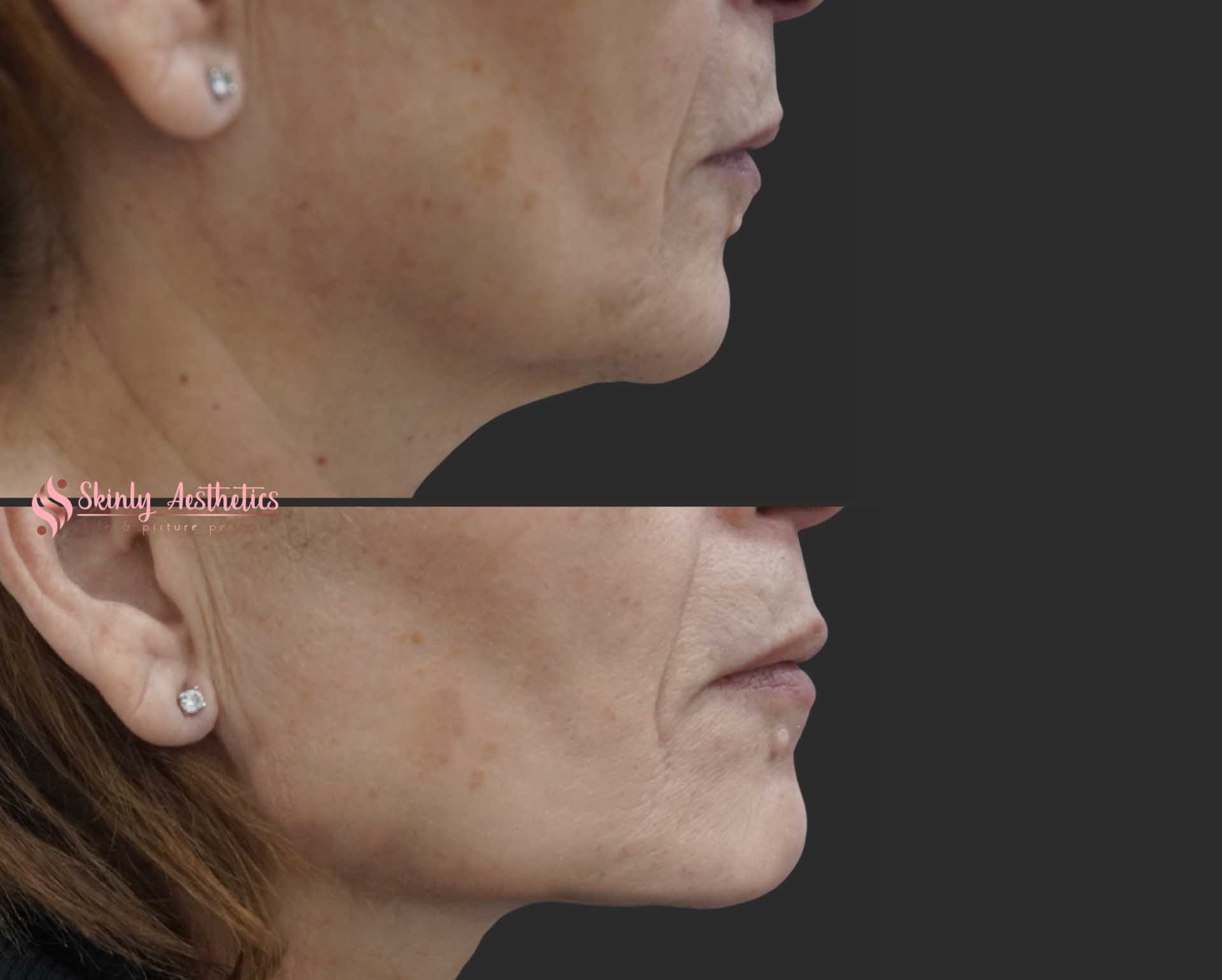 PDO neck lift procedure