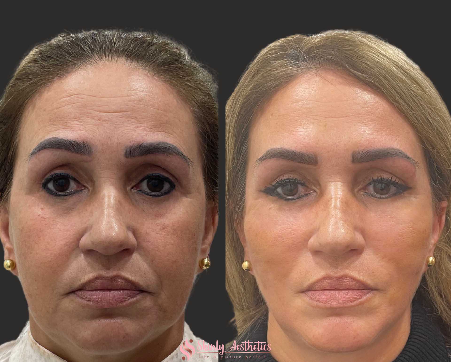 PDO threads for V shaped facelift without surgery