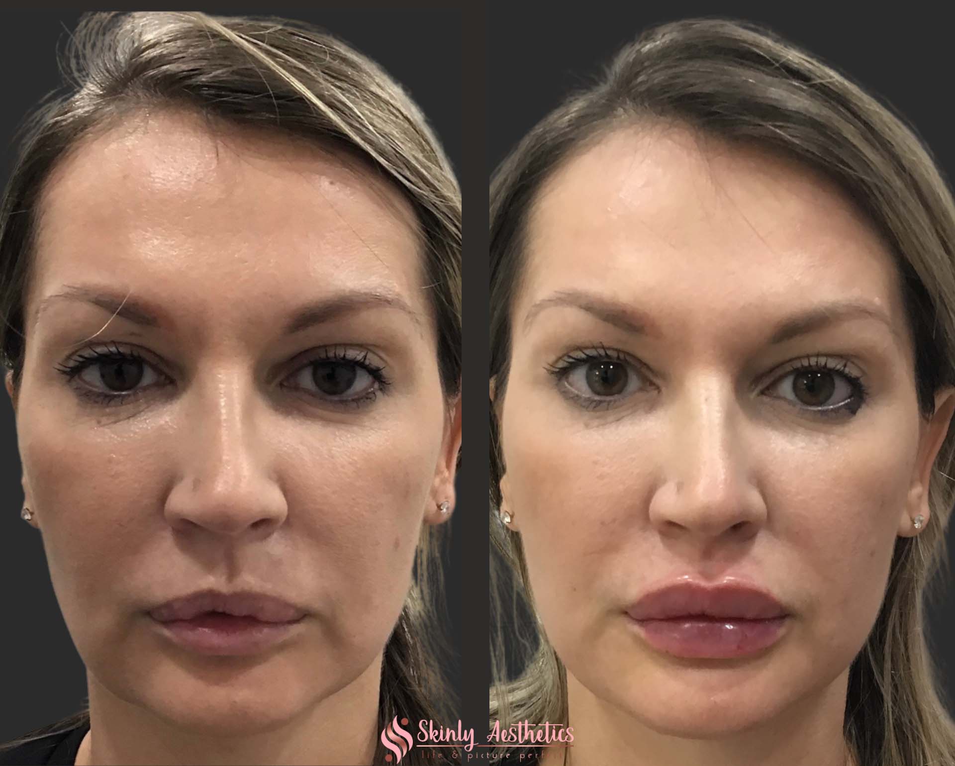 Russian style lip filler augmentation