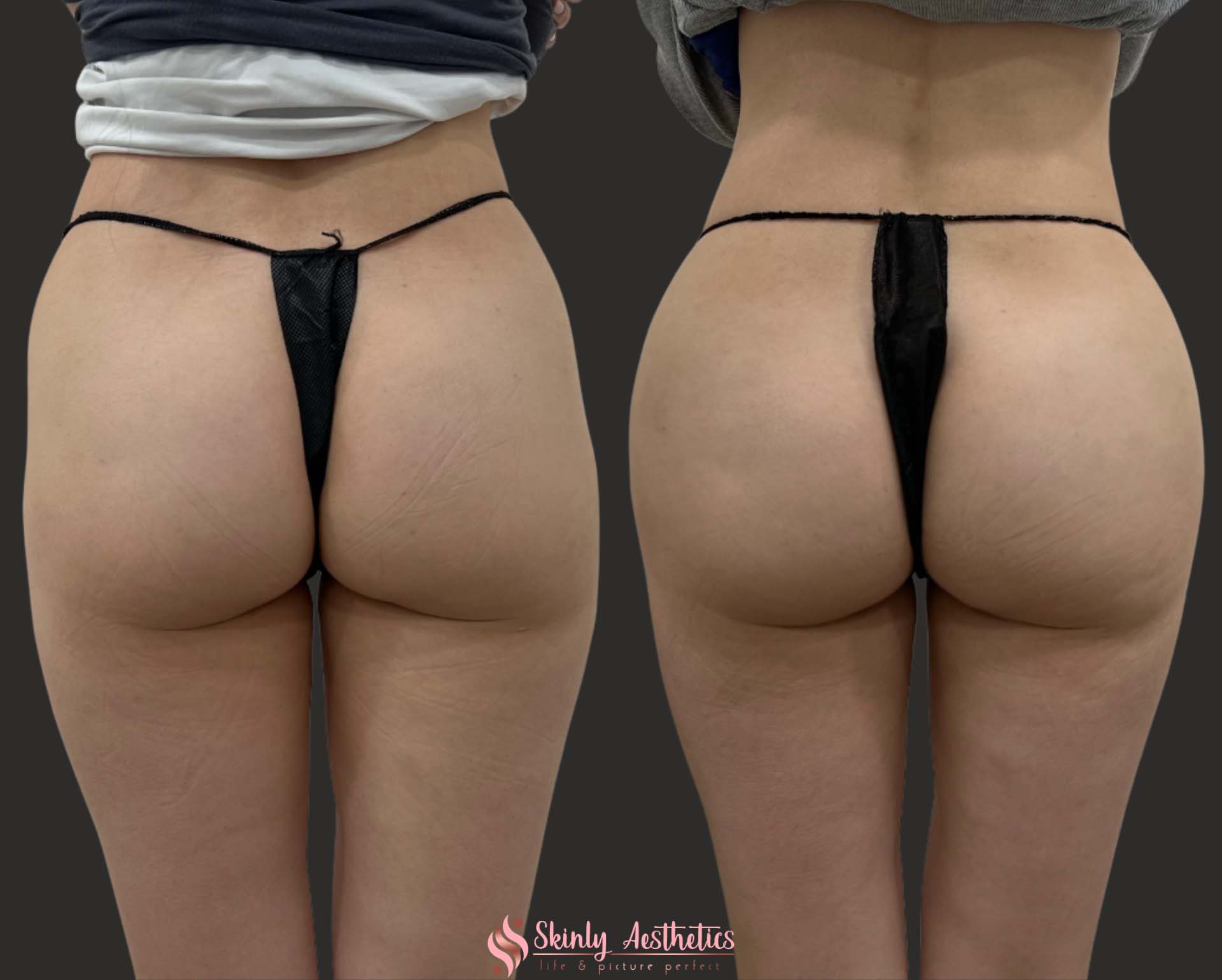 Sculptra bubble butt injections