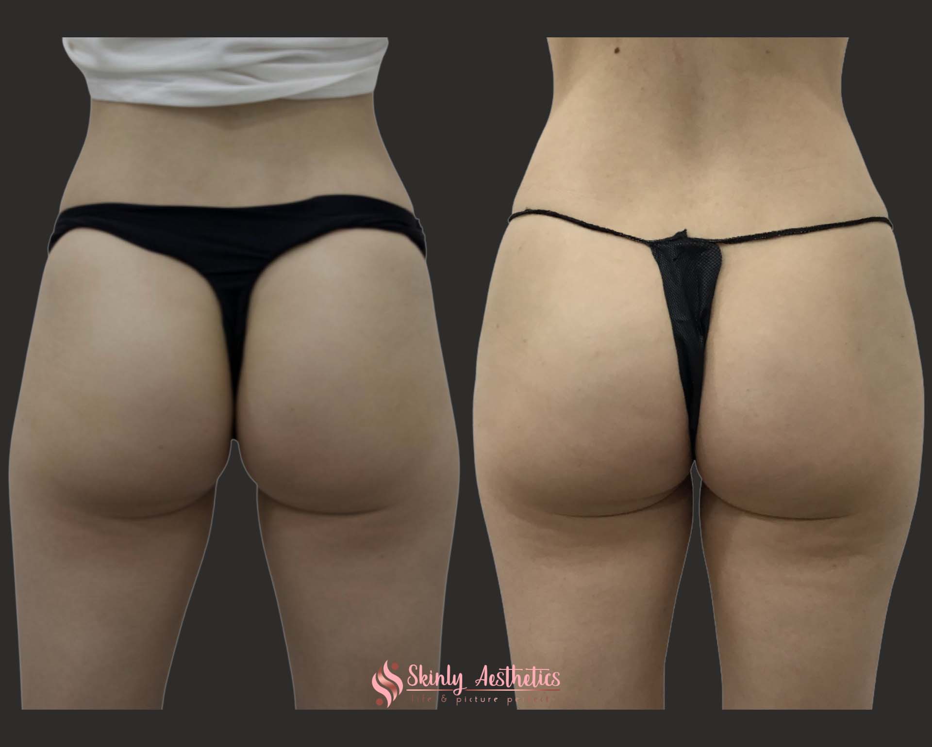 Sculptra filler hips results