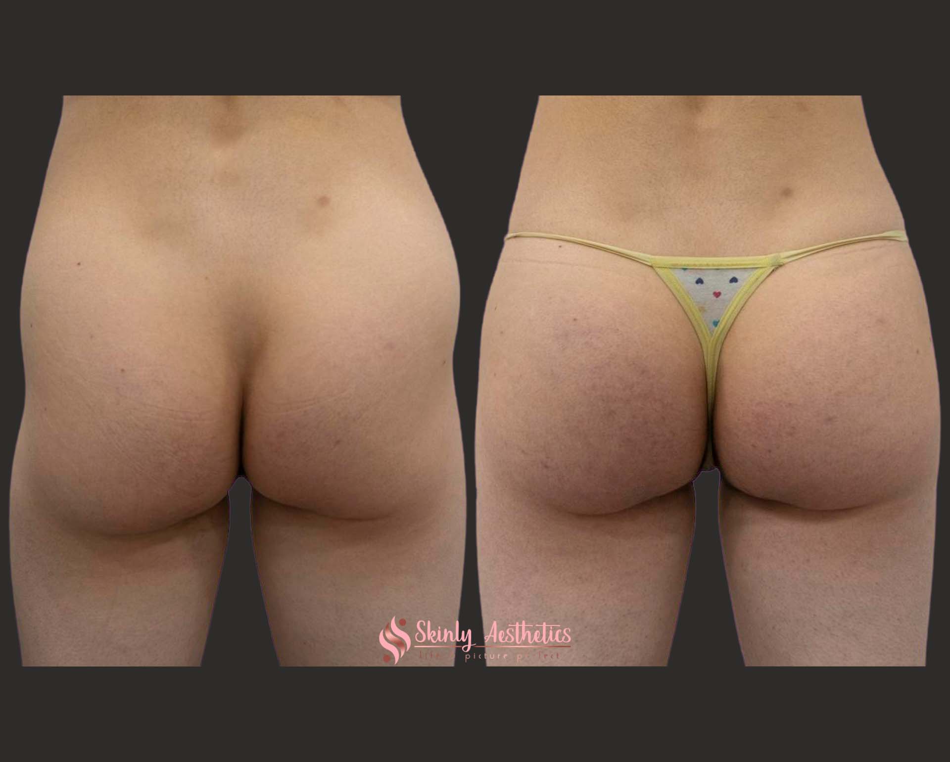Sculptra hip dips treatment