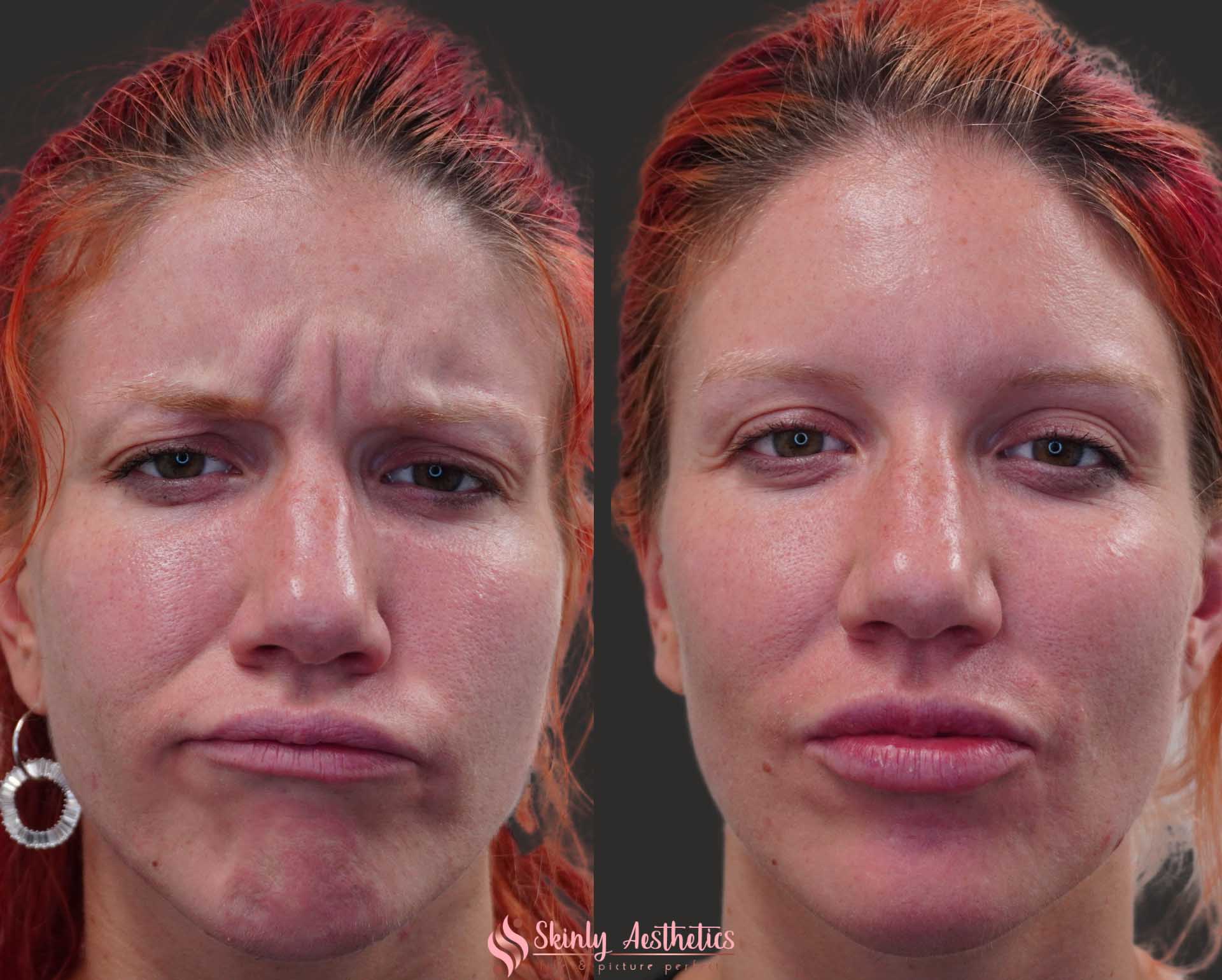 botox 11s lines