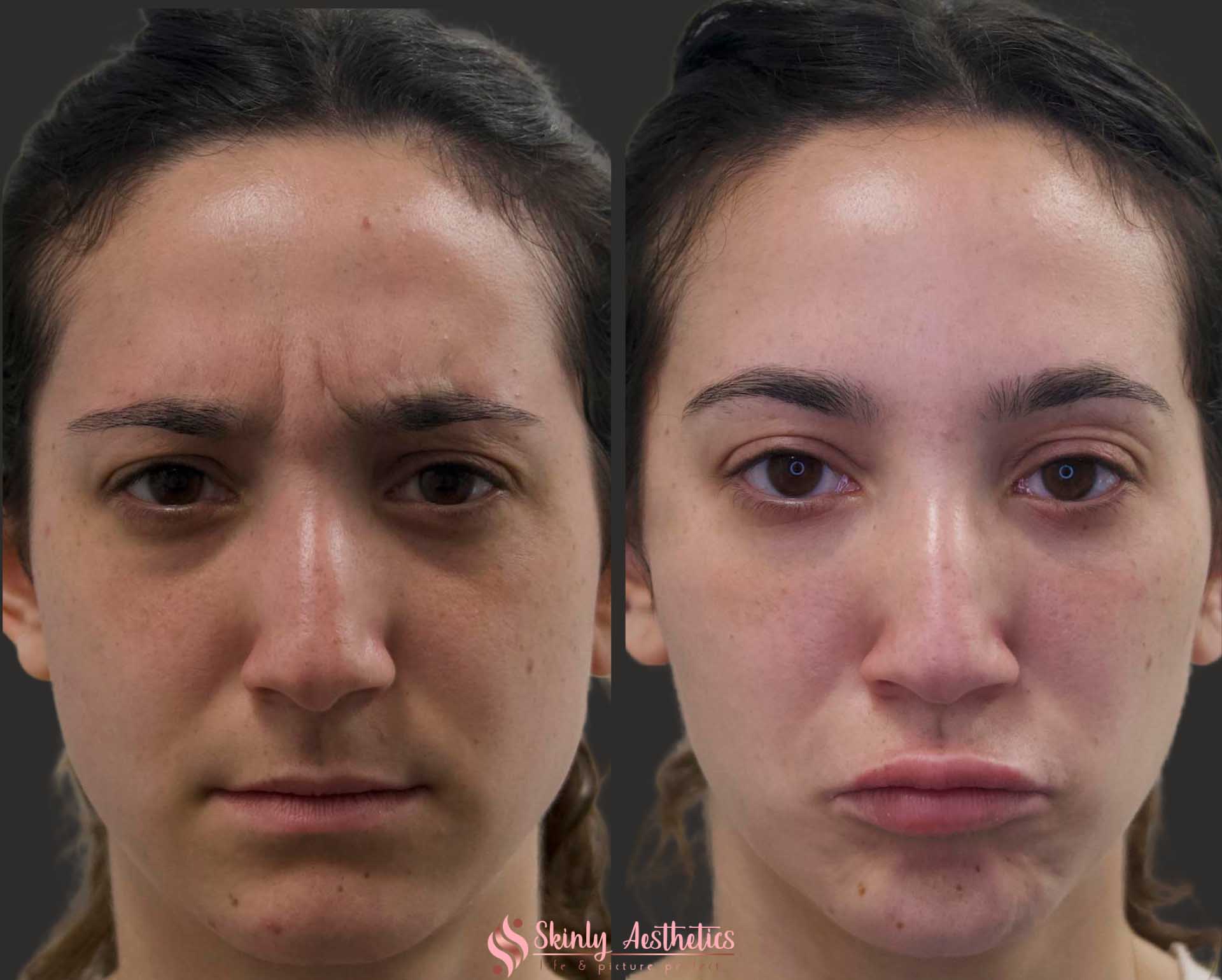 botox 11s wrinkles