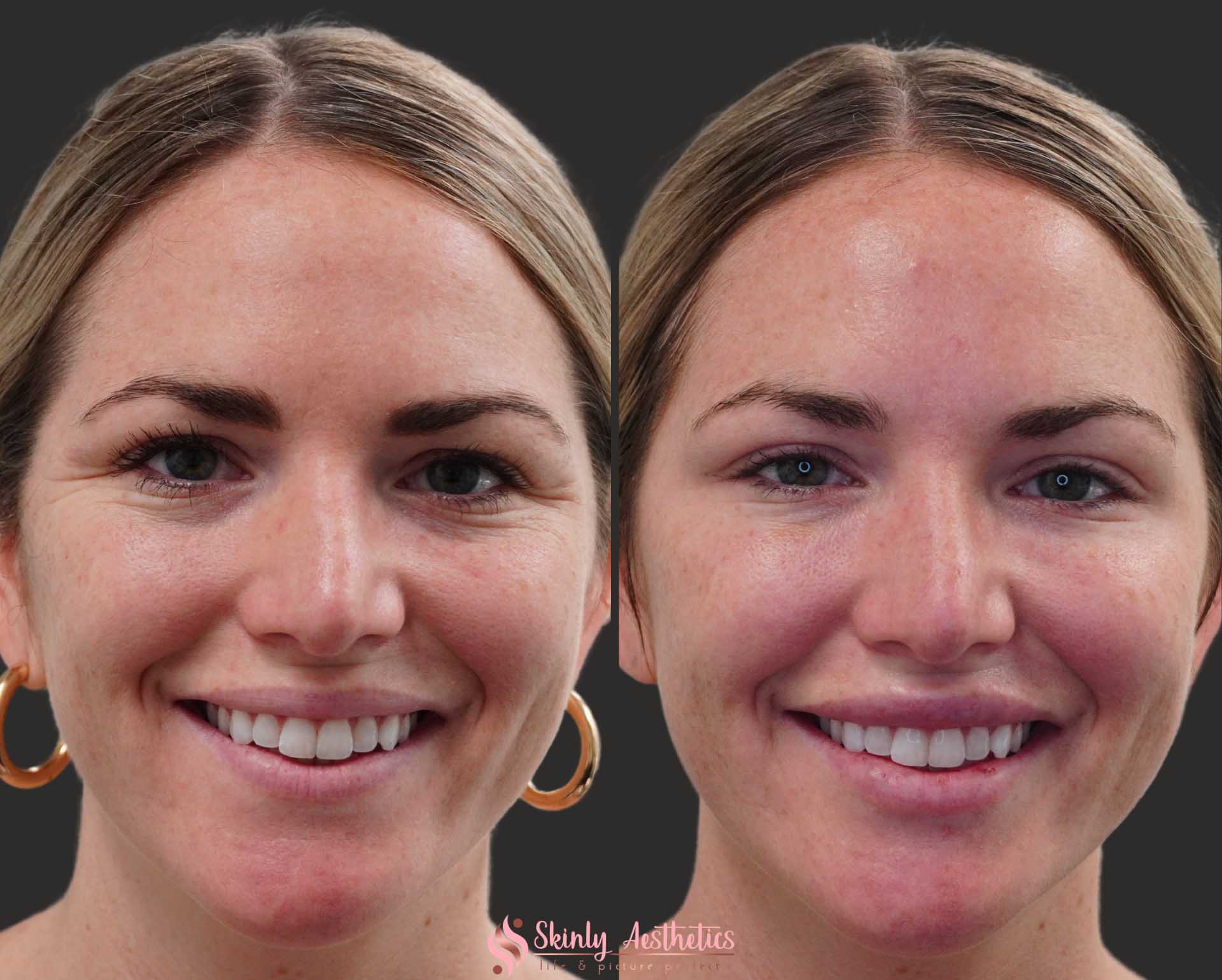botox treatment crows feet