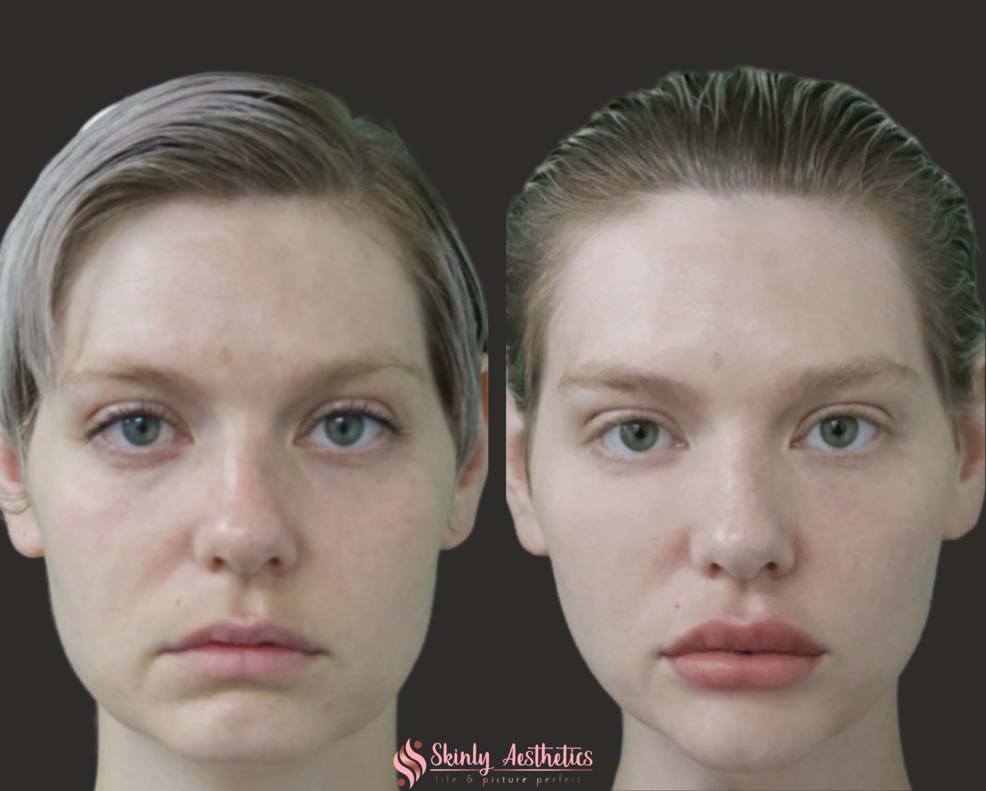 cheek enhancement and skin lifting with dermal fillers