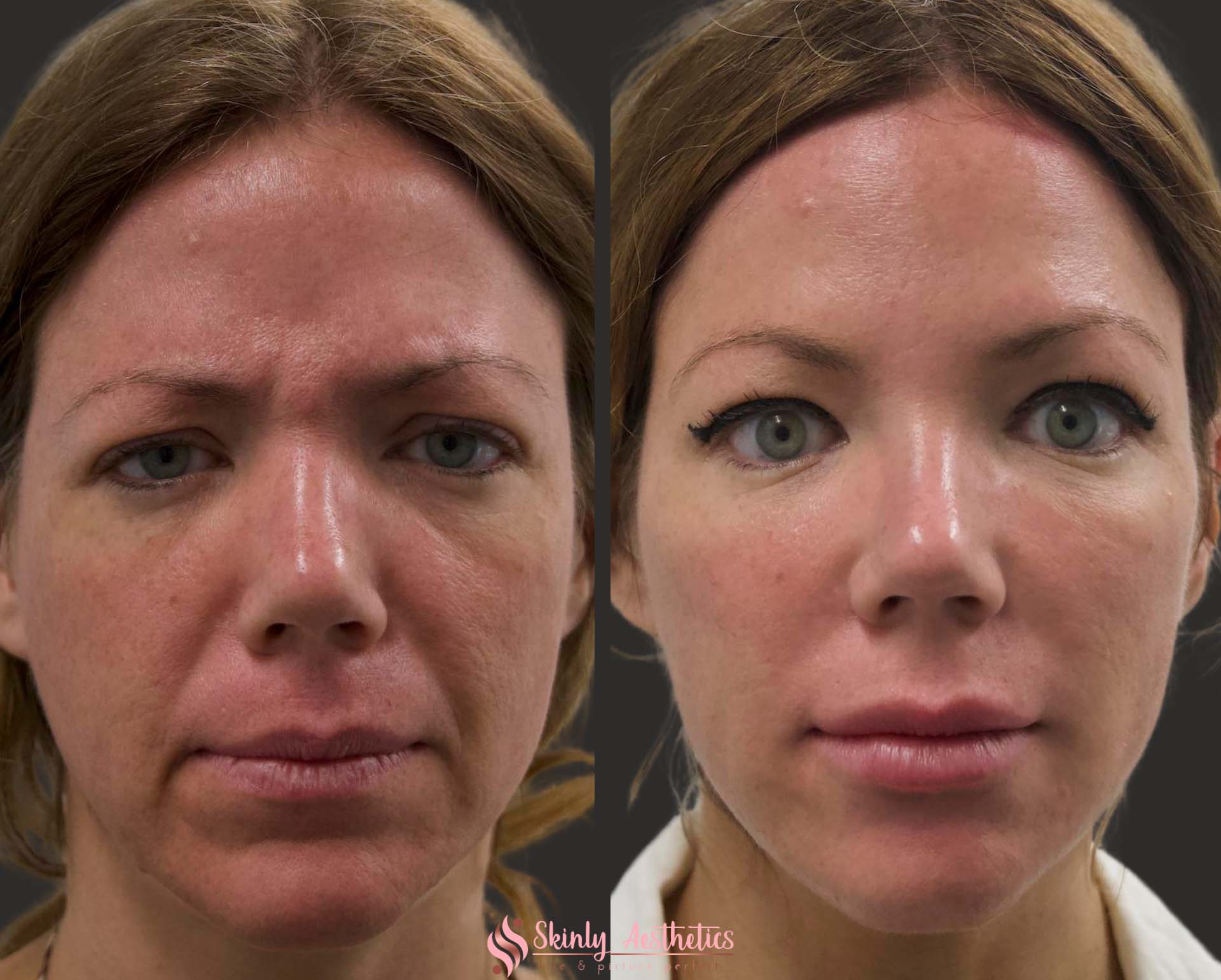 cheek filler augmentation with juvederm voluma