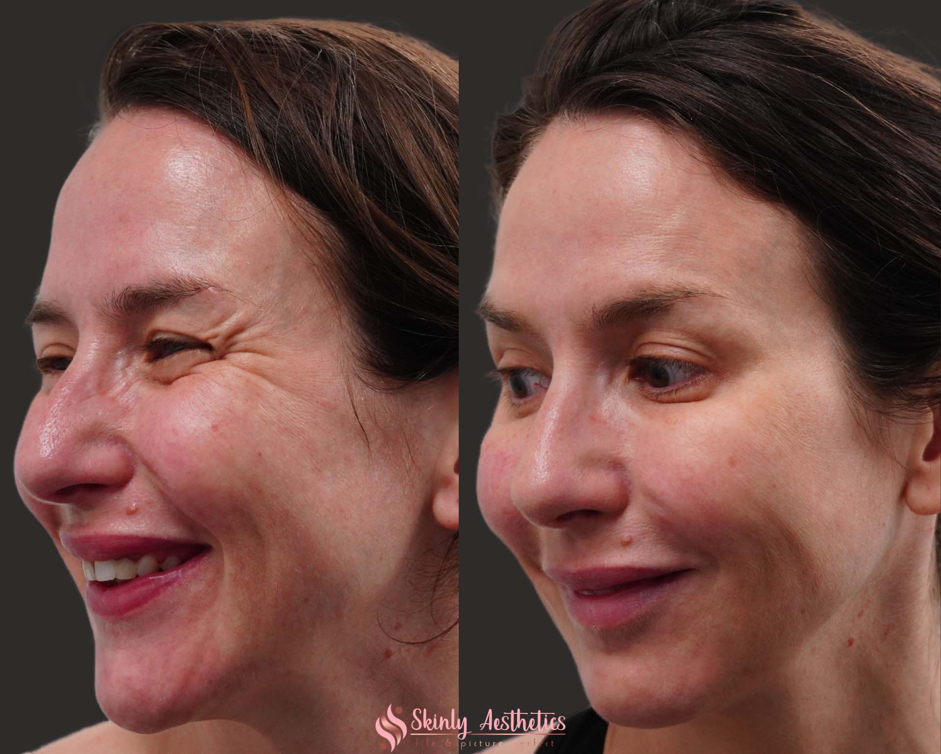 crows feet reduction with botox