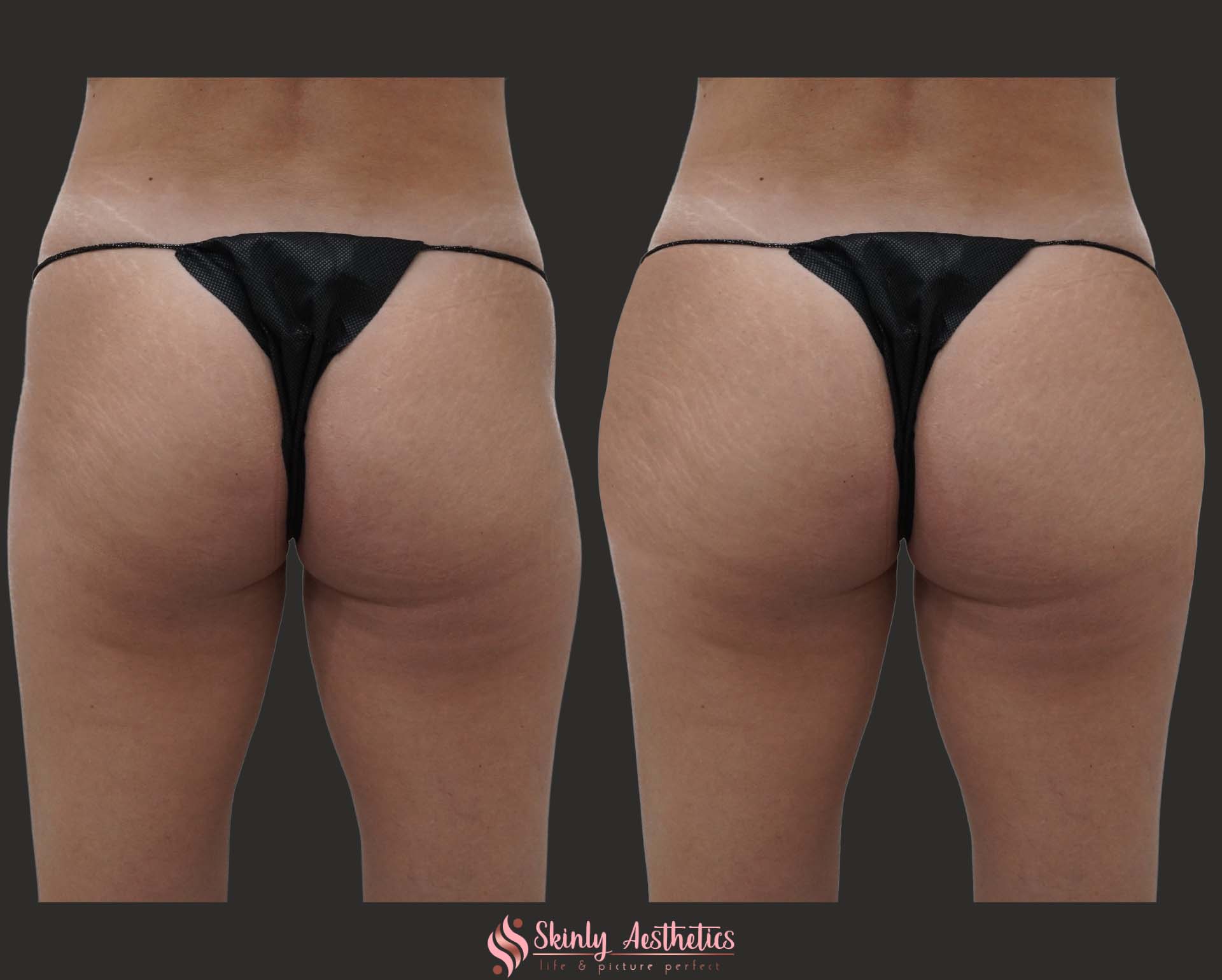 hip dip fillers
