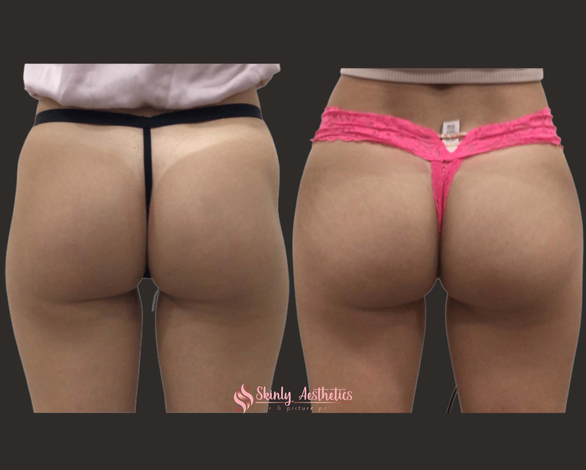 hip dips filler injections