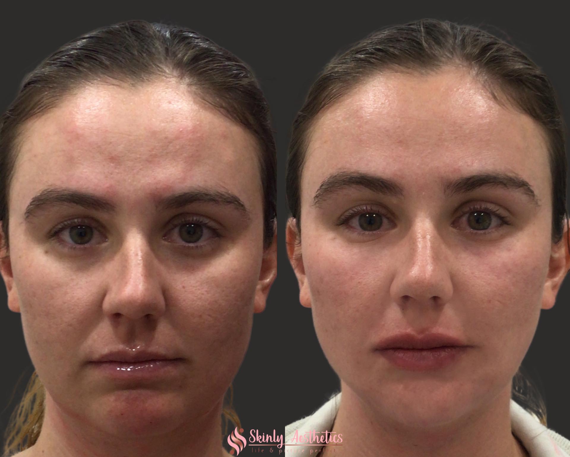 juvederm ultra lip filler enhancement