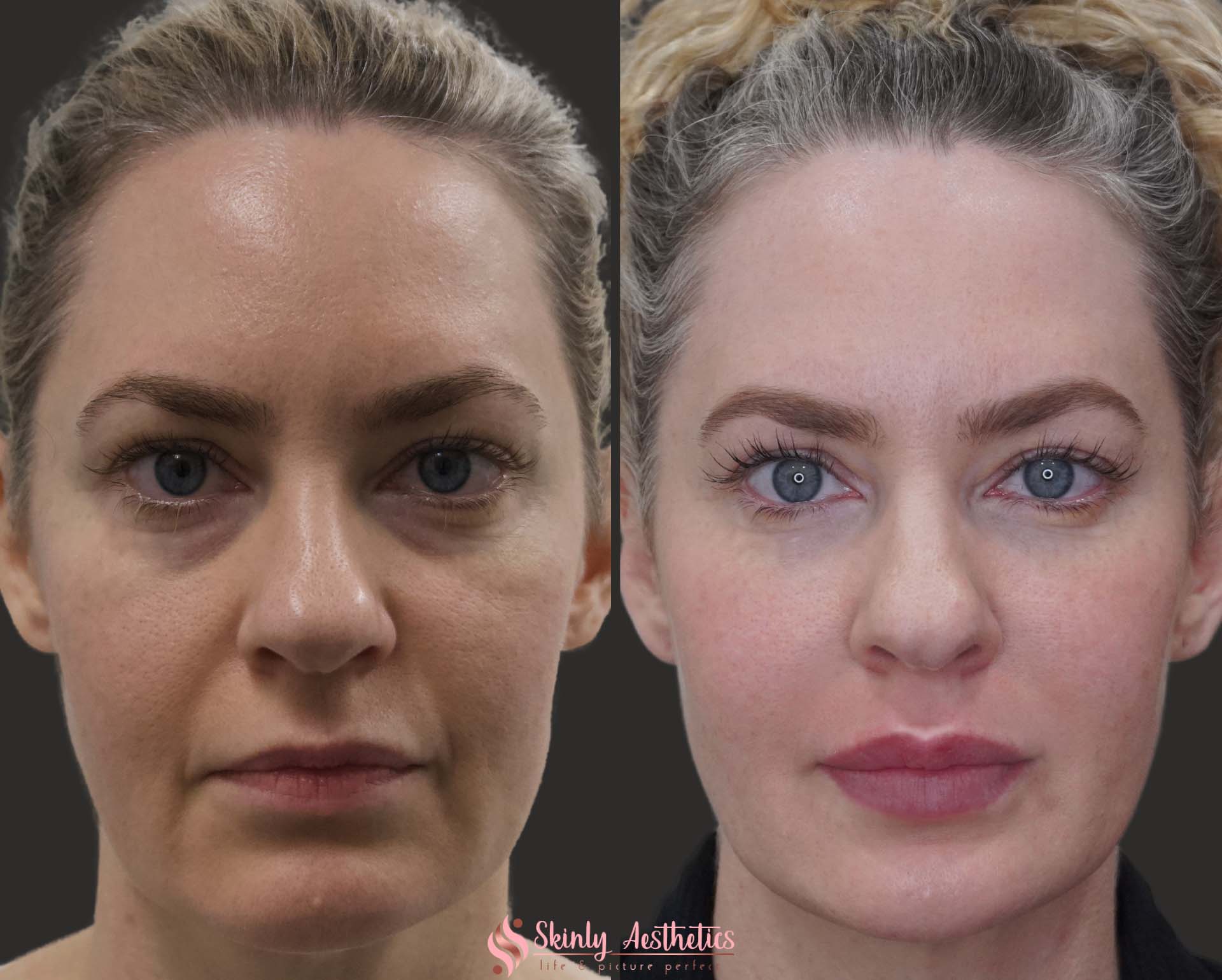 lip filler injection juvederm ultra