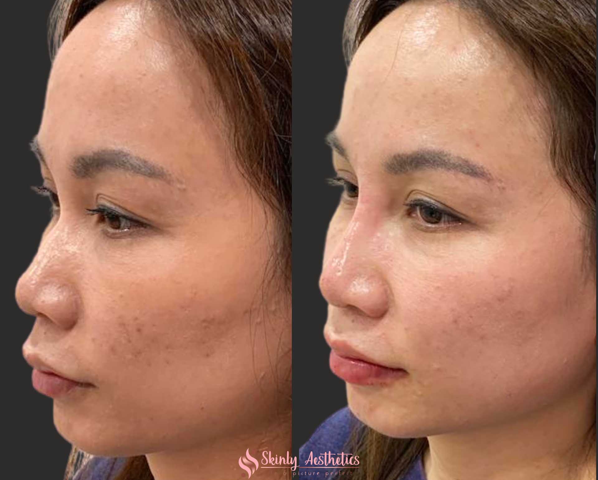 liquid rhinoplasty to augment the nose bridge
