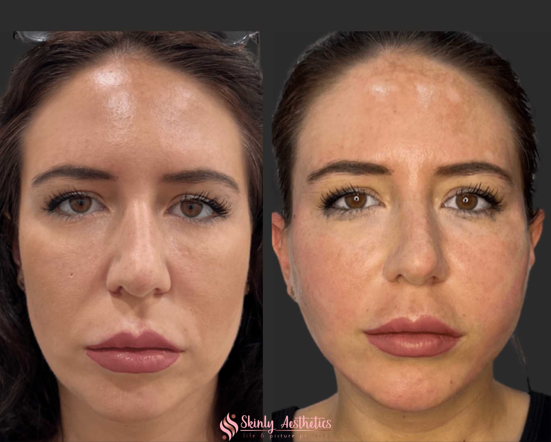 non surgical PDO thread face lift with barbed threads