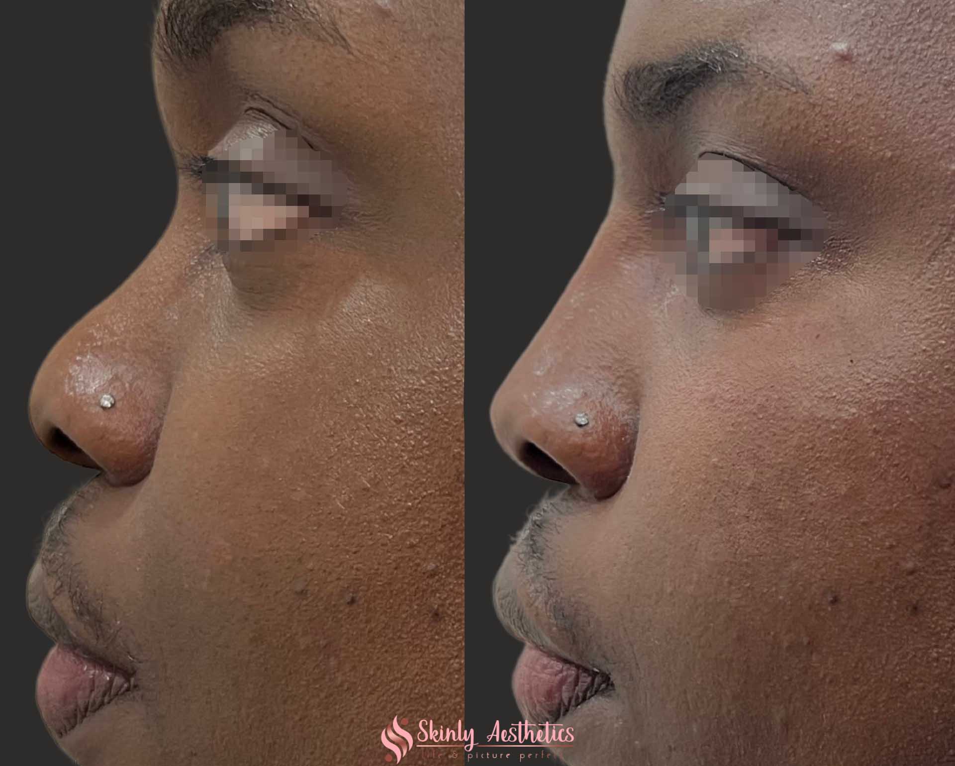 non surgical liquid rhinoplasty for nose bridge and tip augmentation