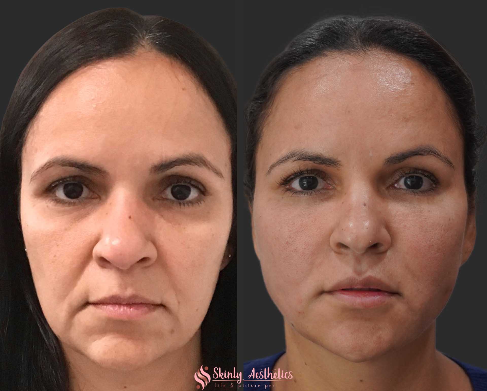 pdo thread lift for sagging skin