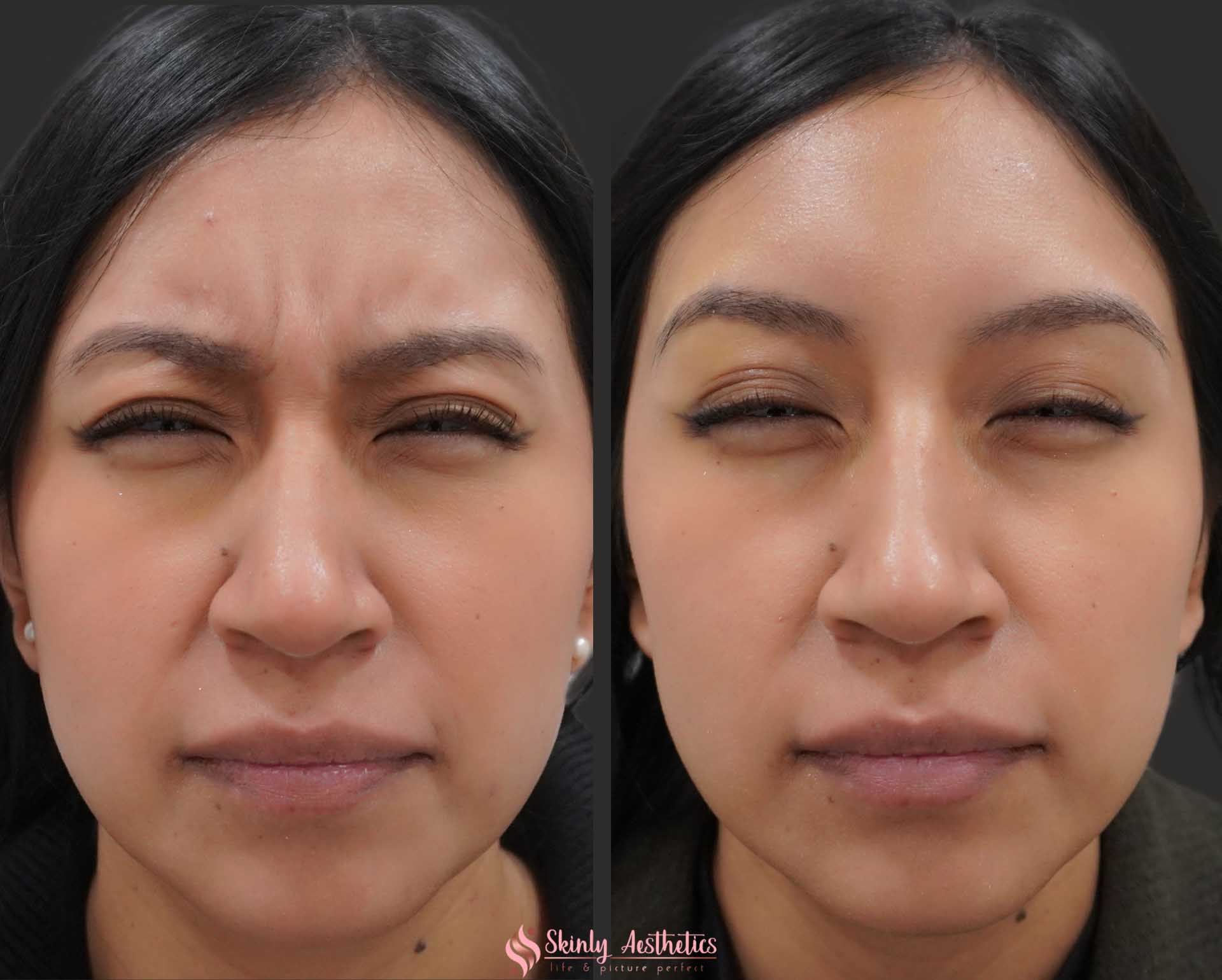 resolution of 11s line following administration of 20 units of Botox