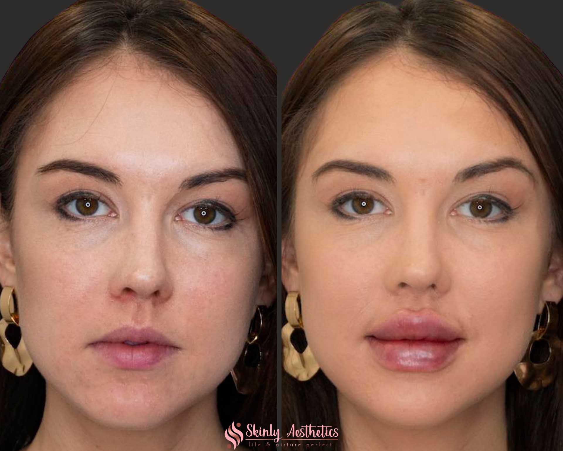 russian lip filler injection technique juvederm ultra