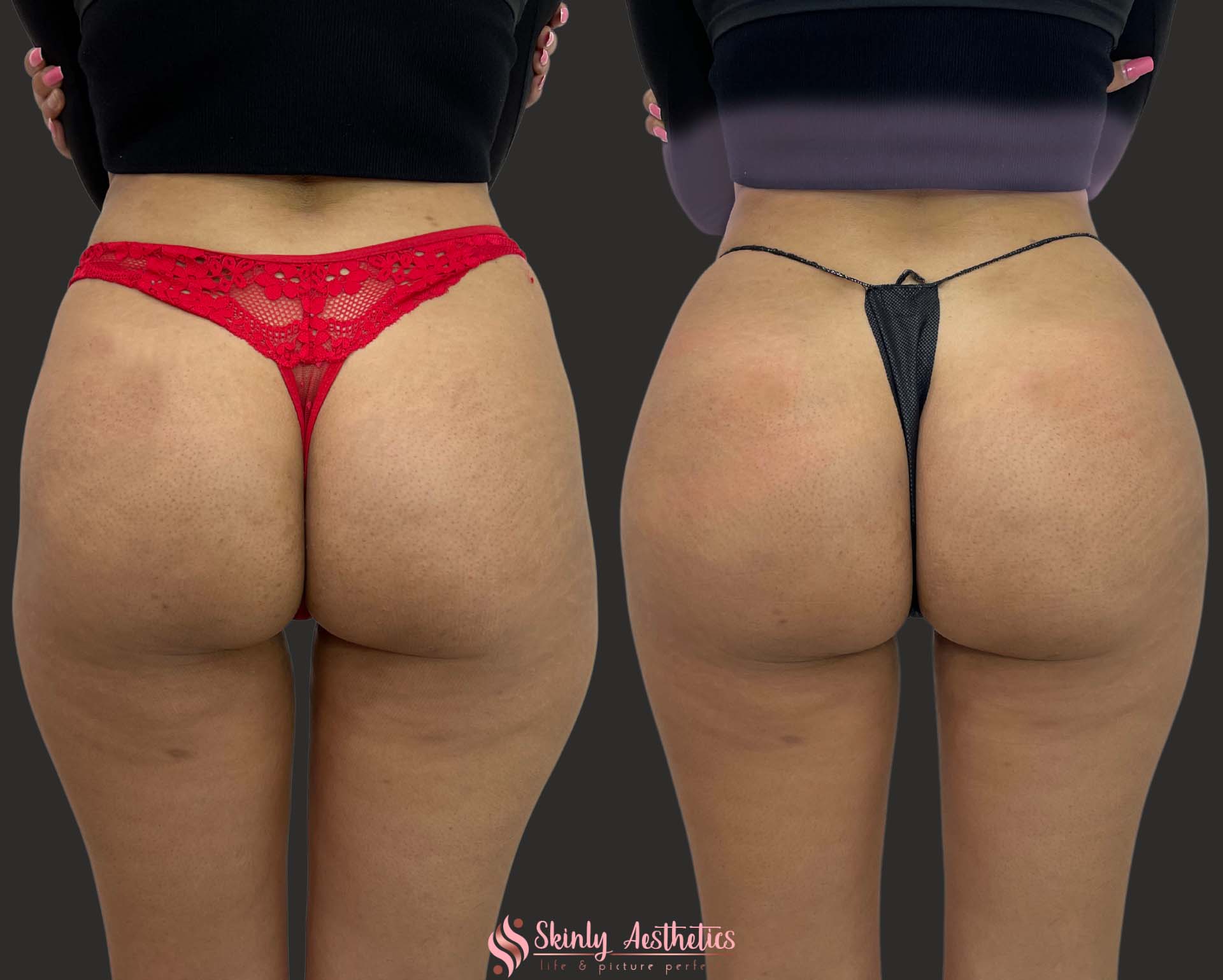 sculptra butt