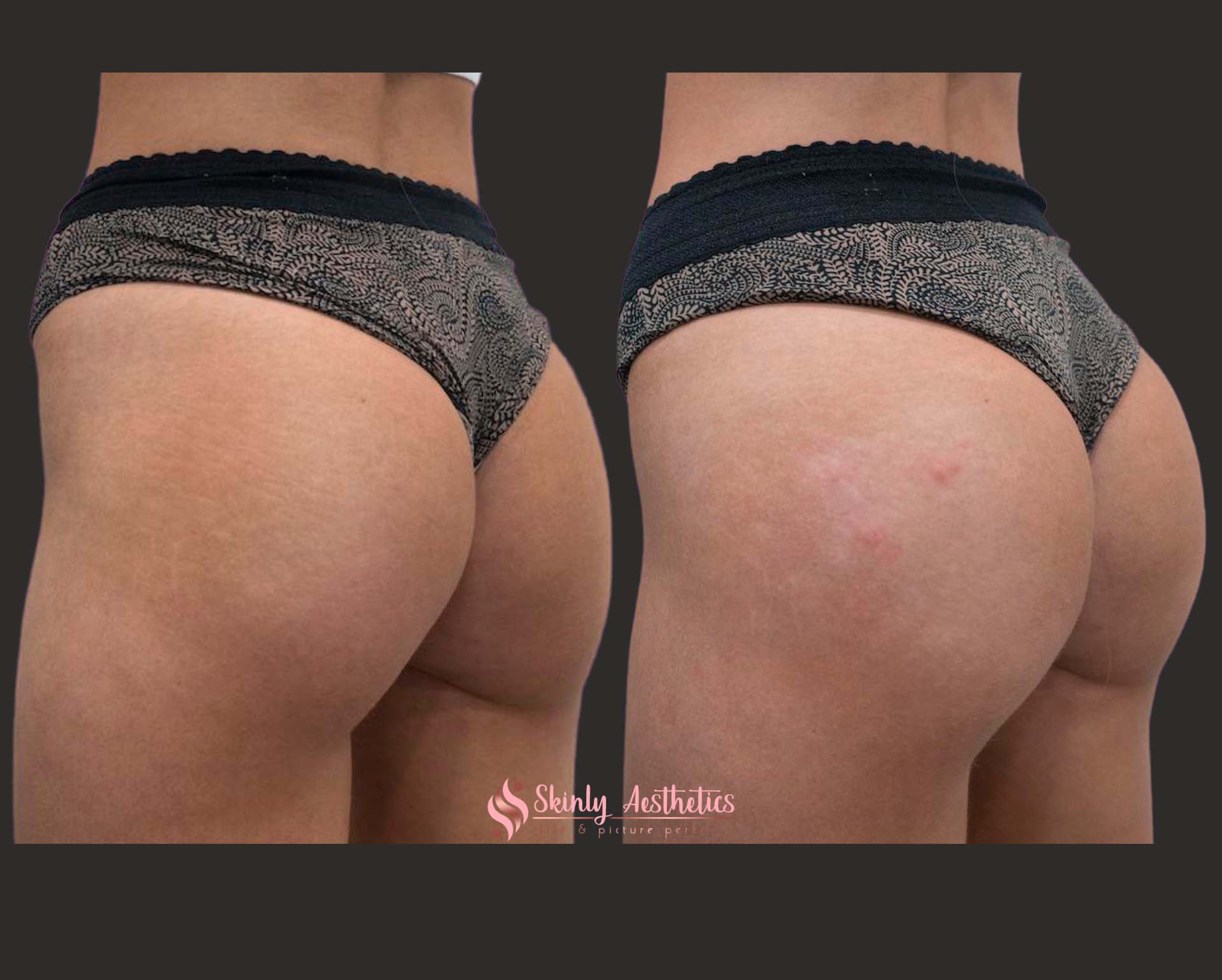 scuptra hips treatment