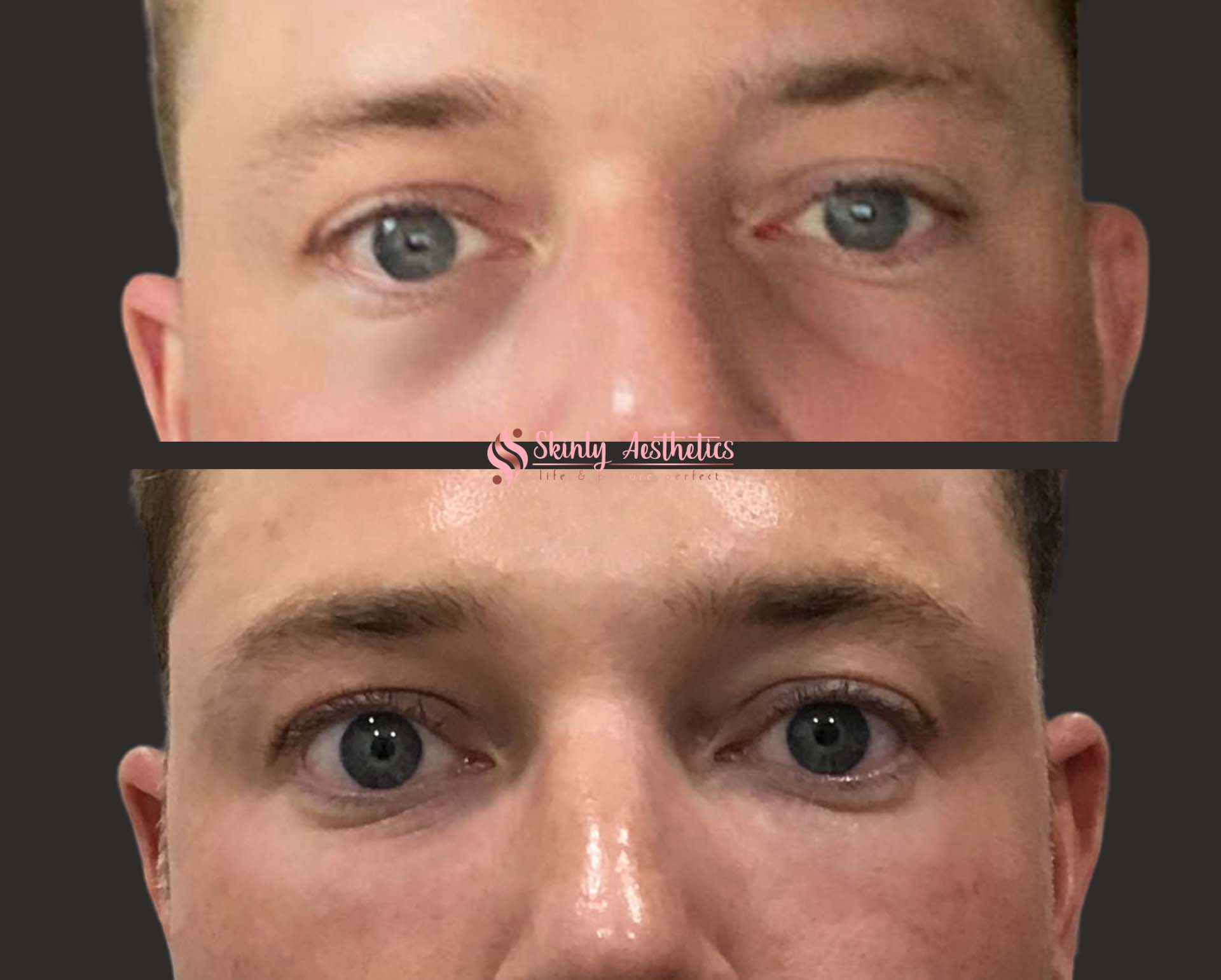 tear trough treatment with Juvederm Voluma