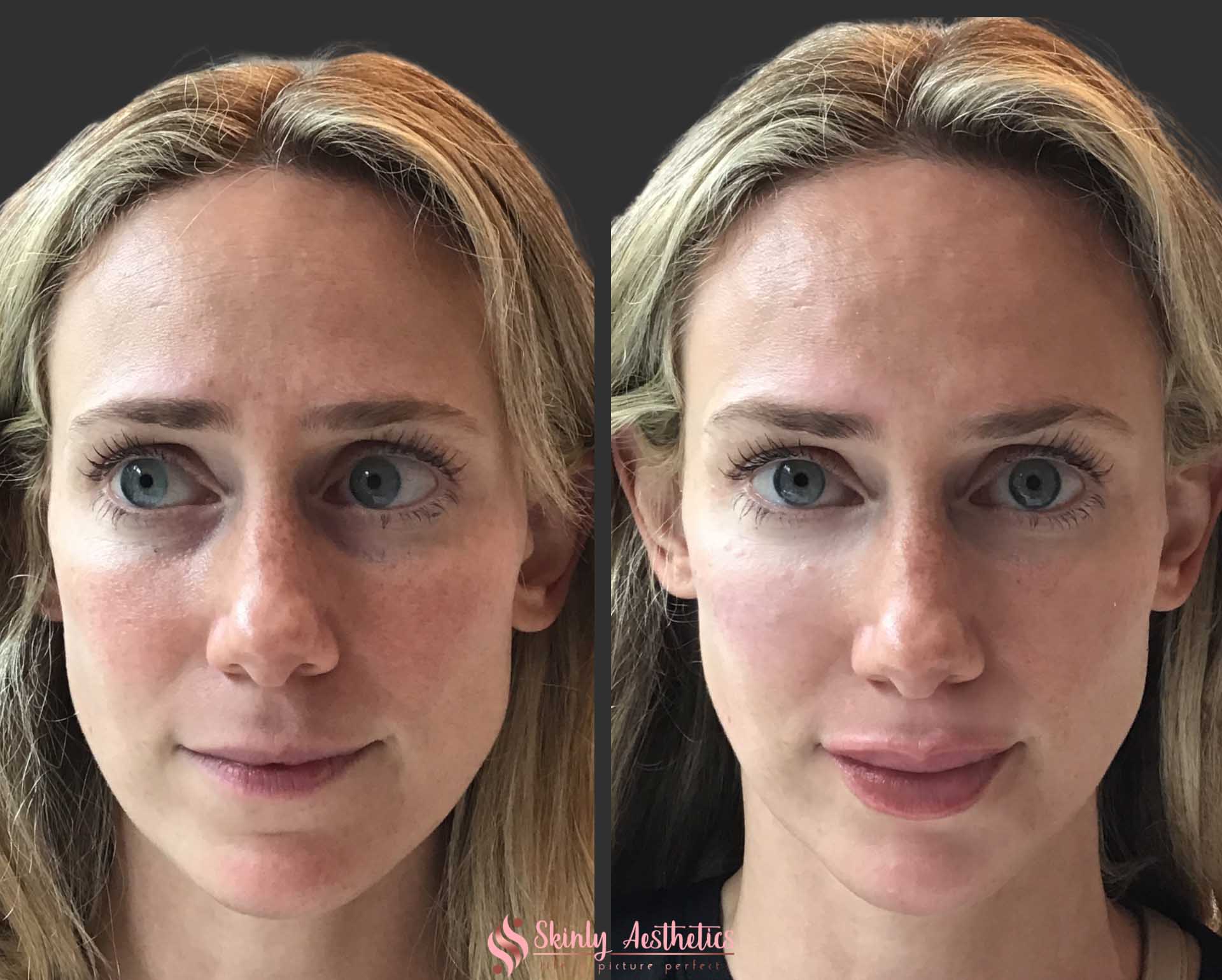 under eye circle treatment with Restylane filler