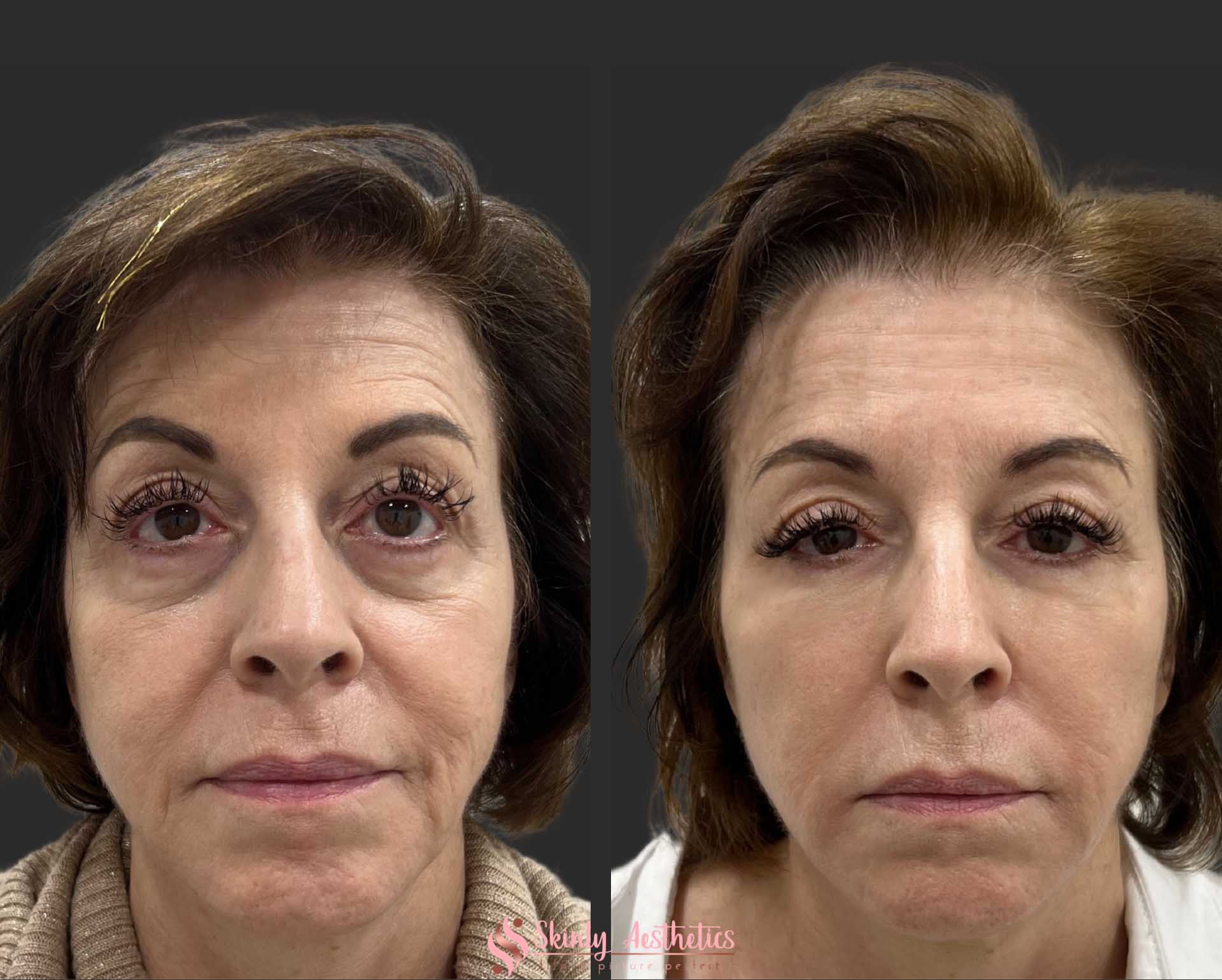under eye circles treatment Juvederm filler