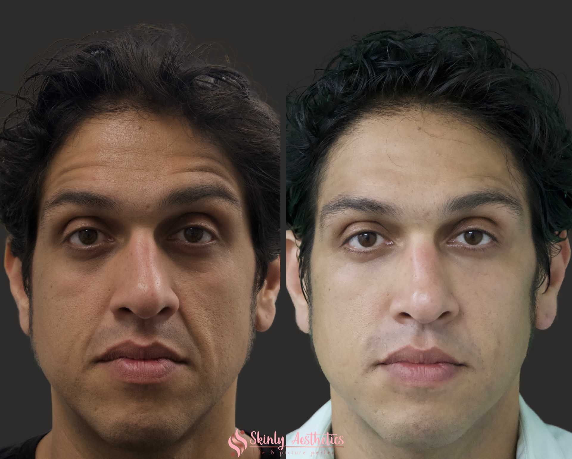 under eye dark circles treated with Juvederm dermal filler
