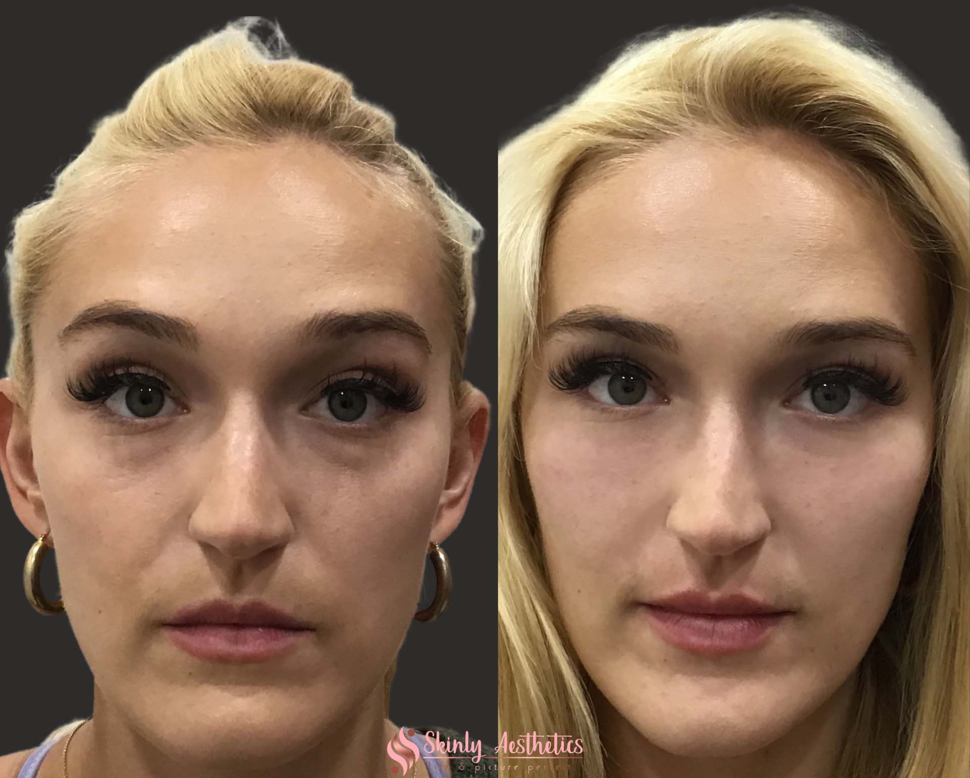 under eye dark circles treated with Restylane