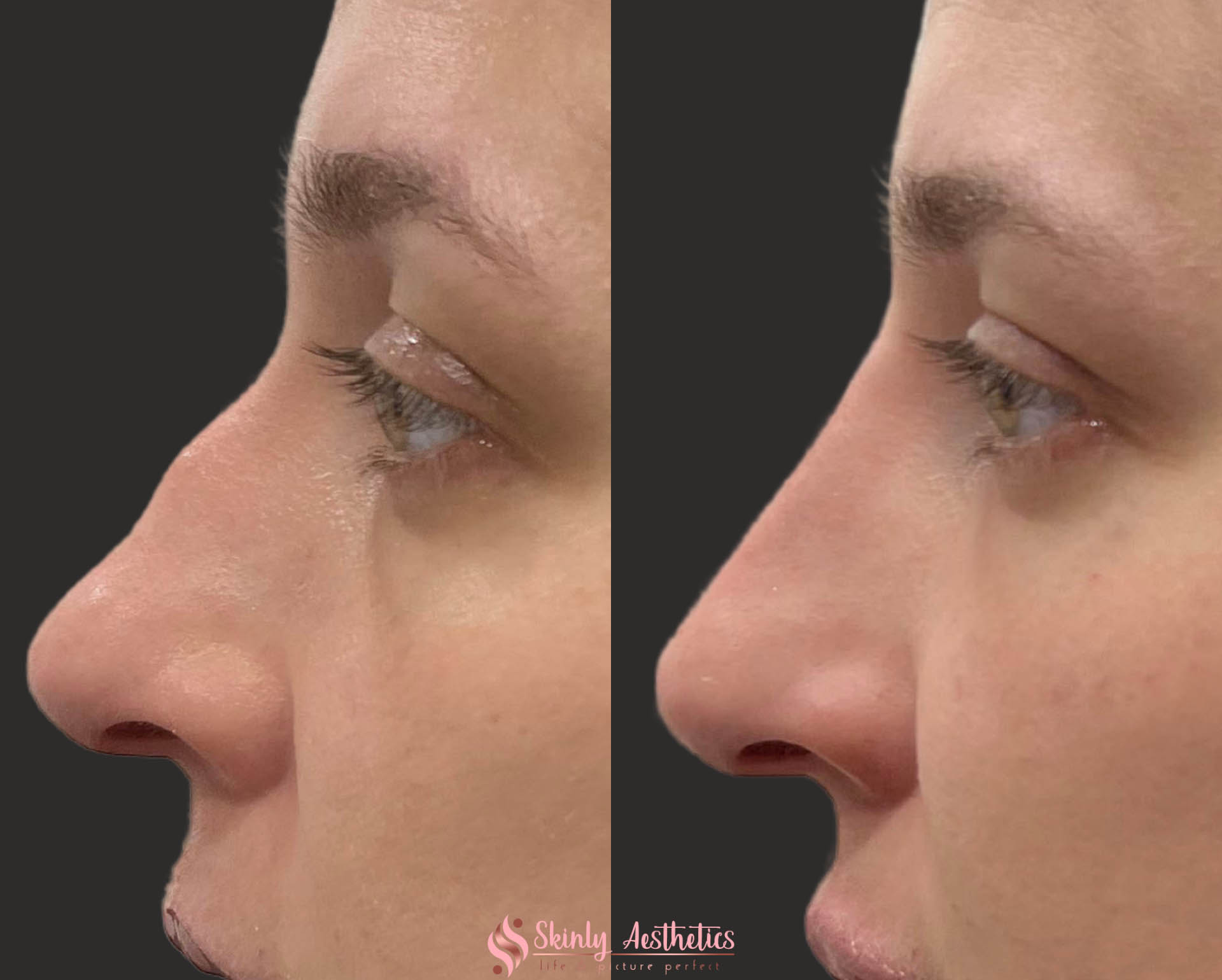liquid rhinoplasty results after 1 syringe of Juvederm Voluma