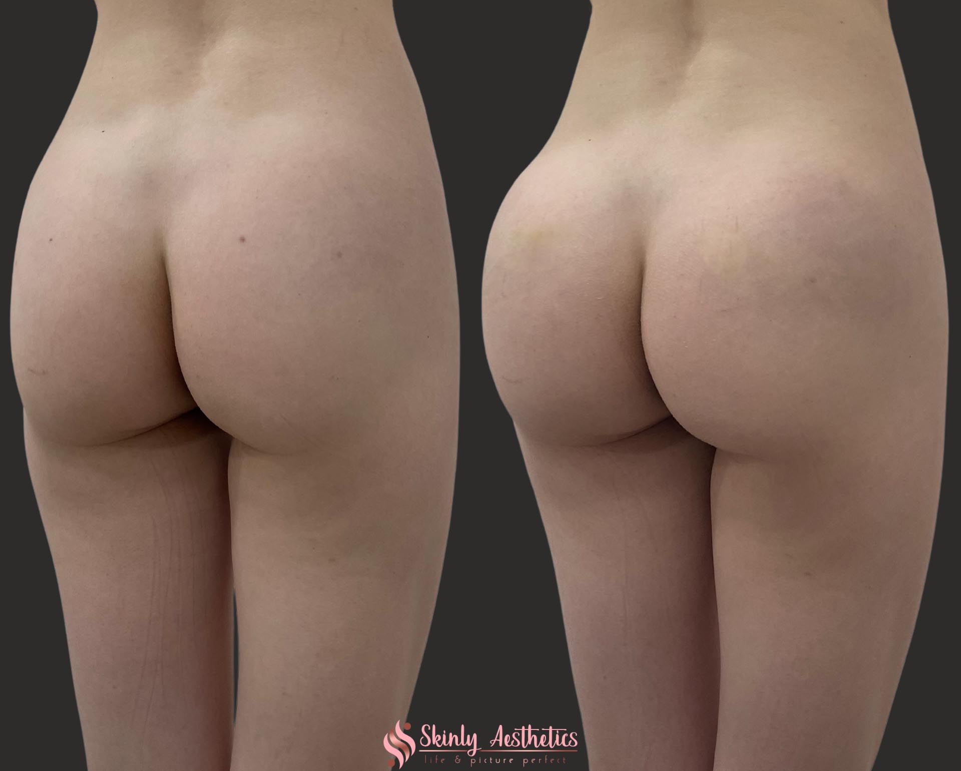 posterior butt sculpting via non surgical enhancement with Sculptra and Radiesse fillers