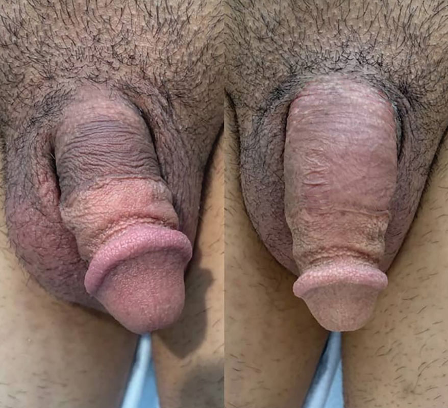 Non Surgical Penile Enhancement With Dermal Fillers