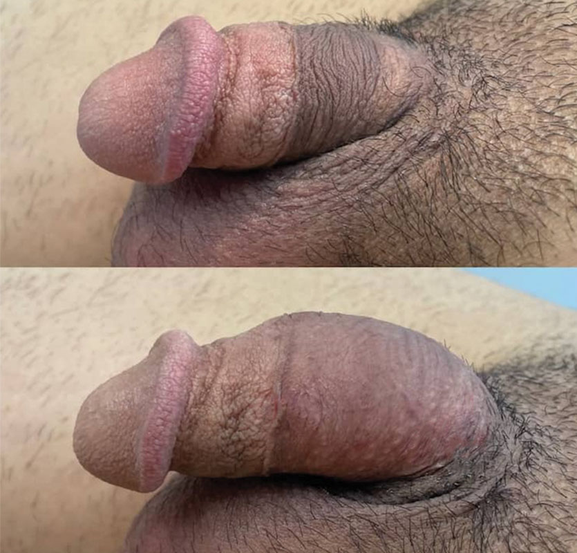 Penis Before And After Filler Injections 
