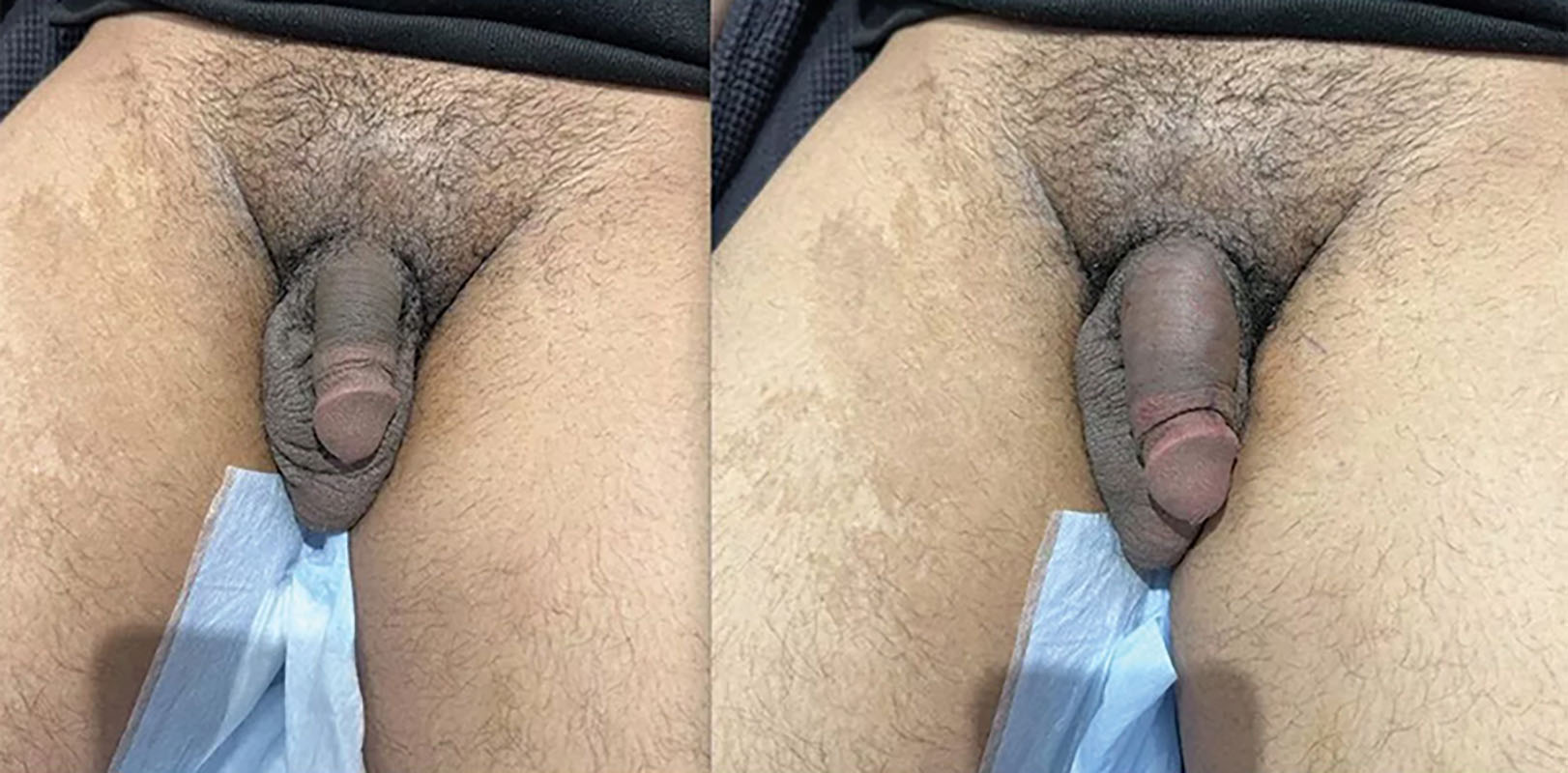 Penile Augmentation with Dermal Fillers
