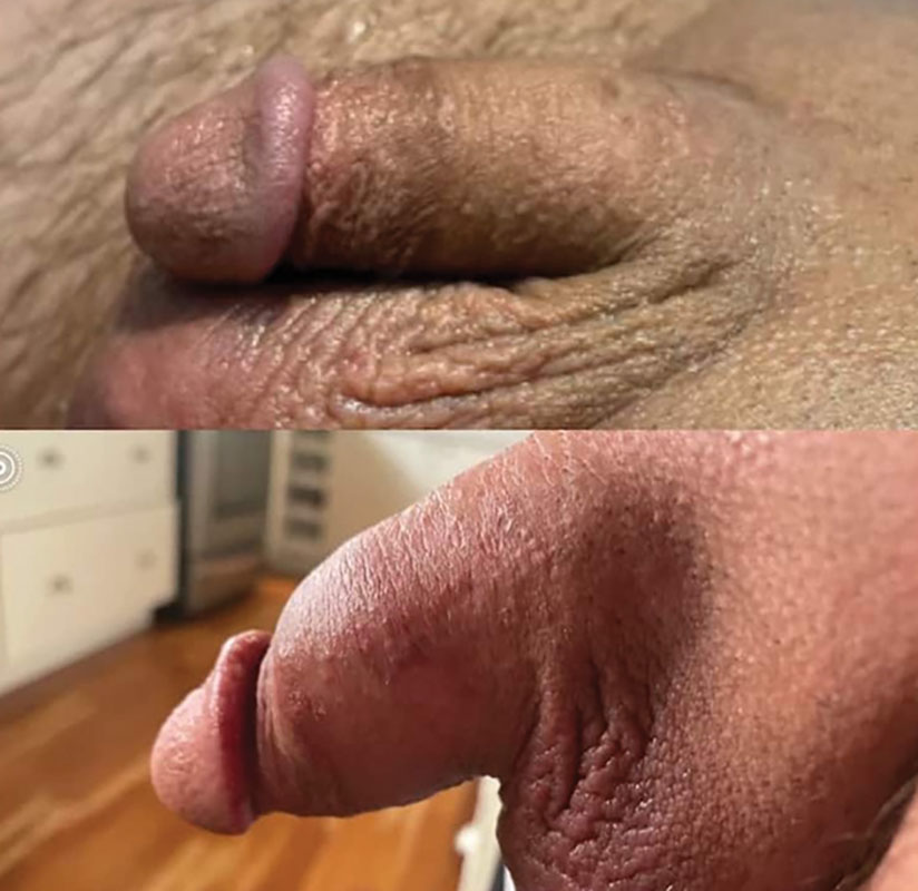 Results After Penis Filler Injections