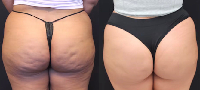 Avéli treatment results on the butt with dimple-free skin
