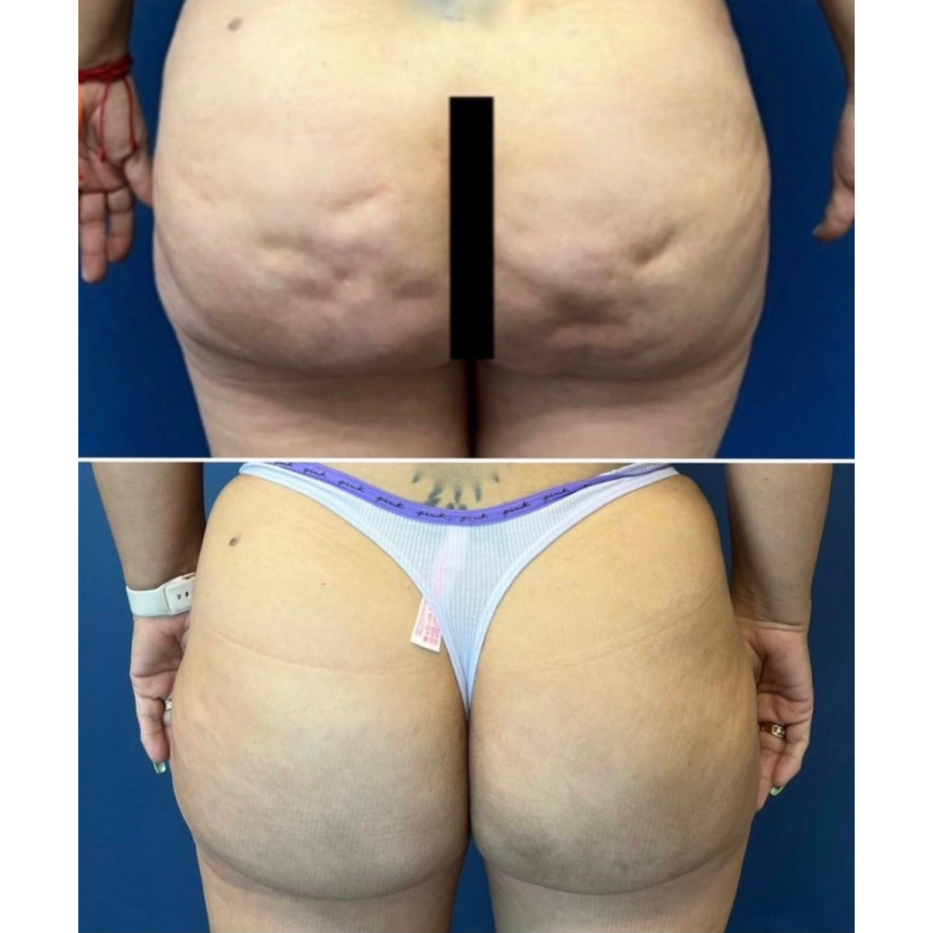 Cellulite butt reduction