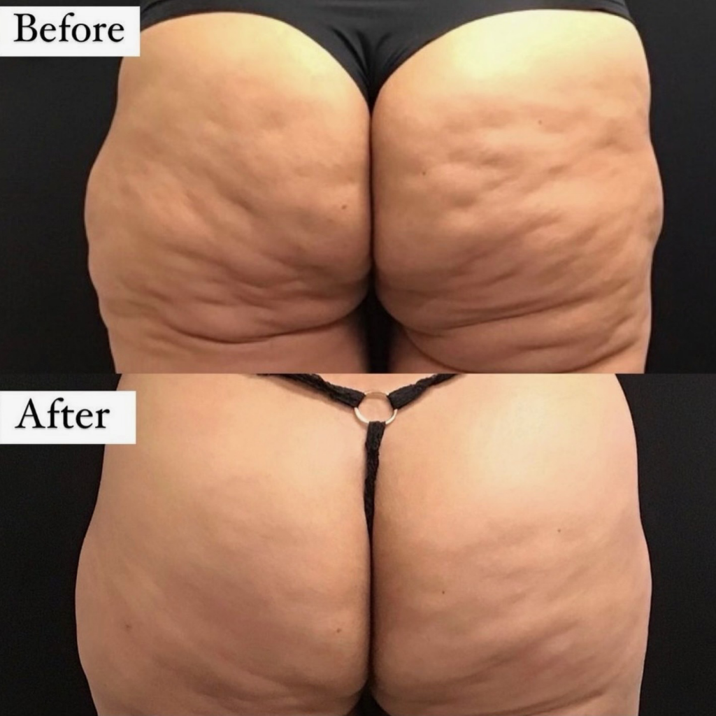 Cellulite reduction on the buttocks after one Avéli session