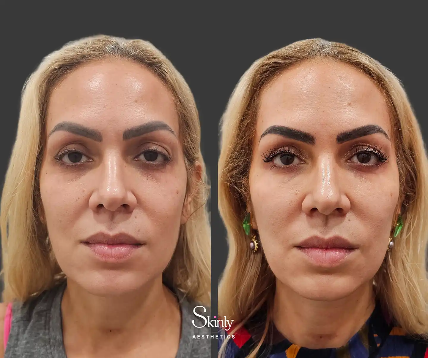Before and after Liquid Facelift showcasing rejuvenated midface volume