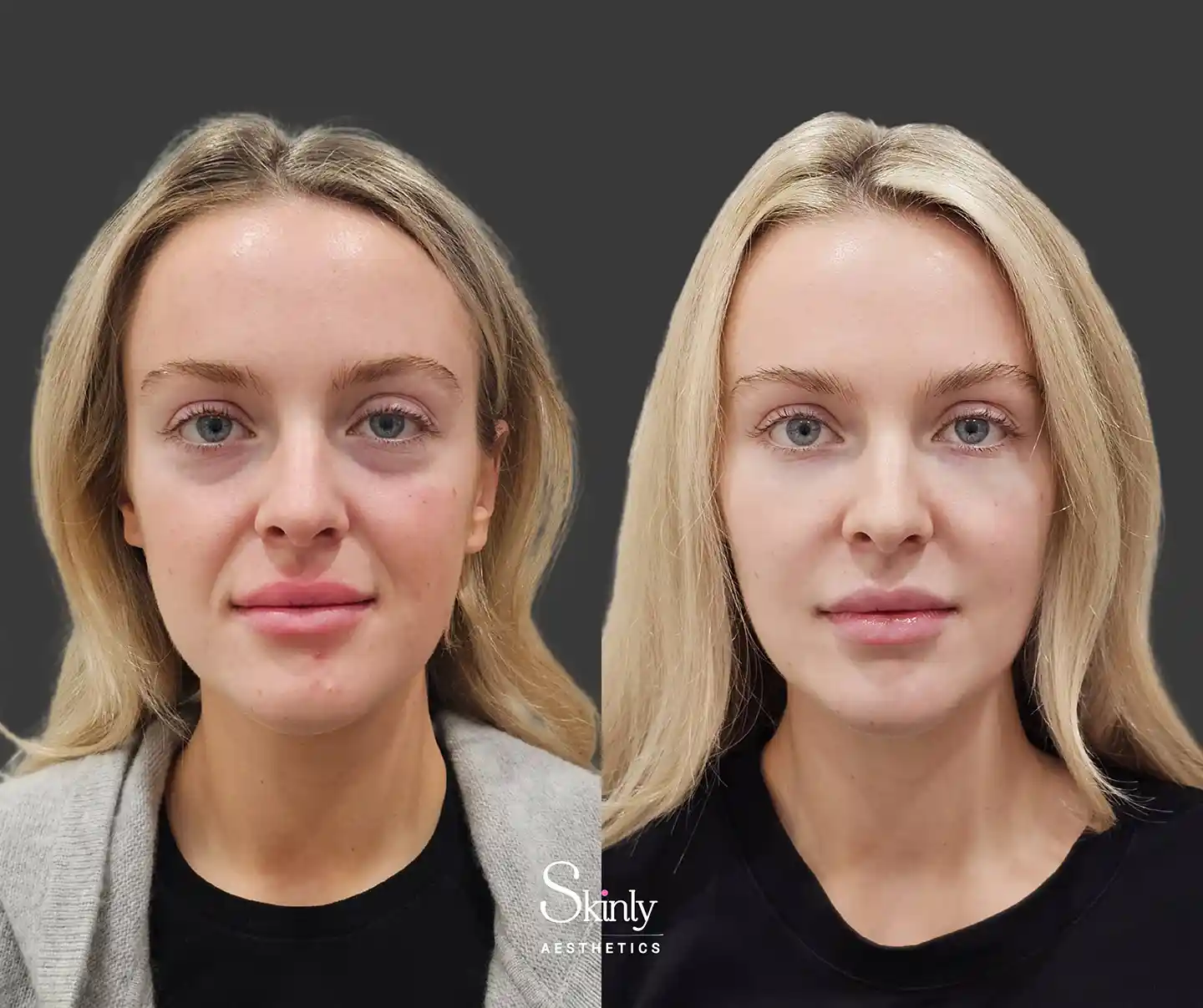 Correction of facial sagging with Liquid Facelift treatment before and after