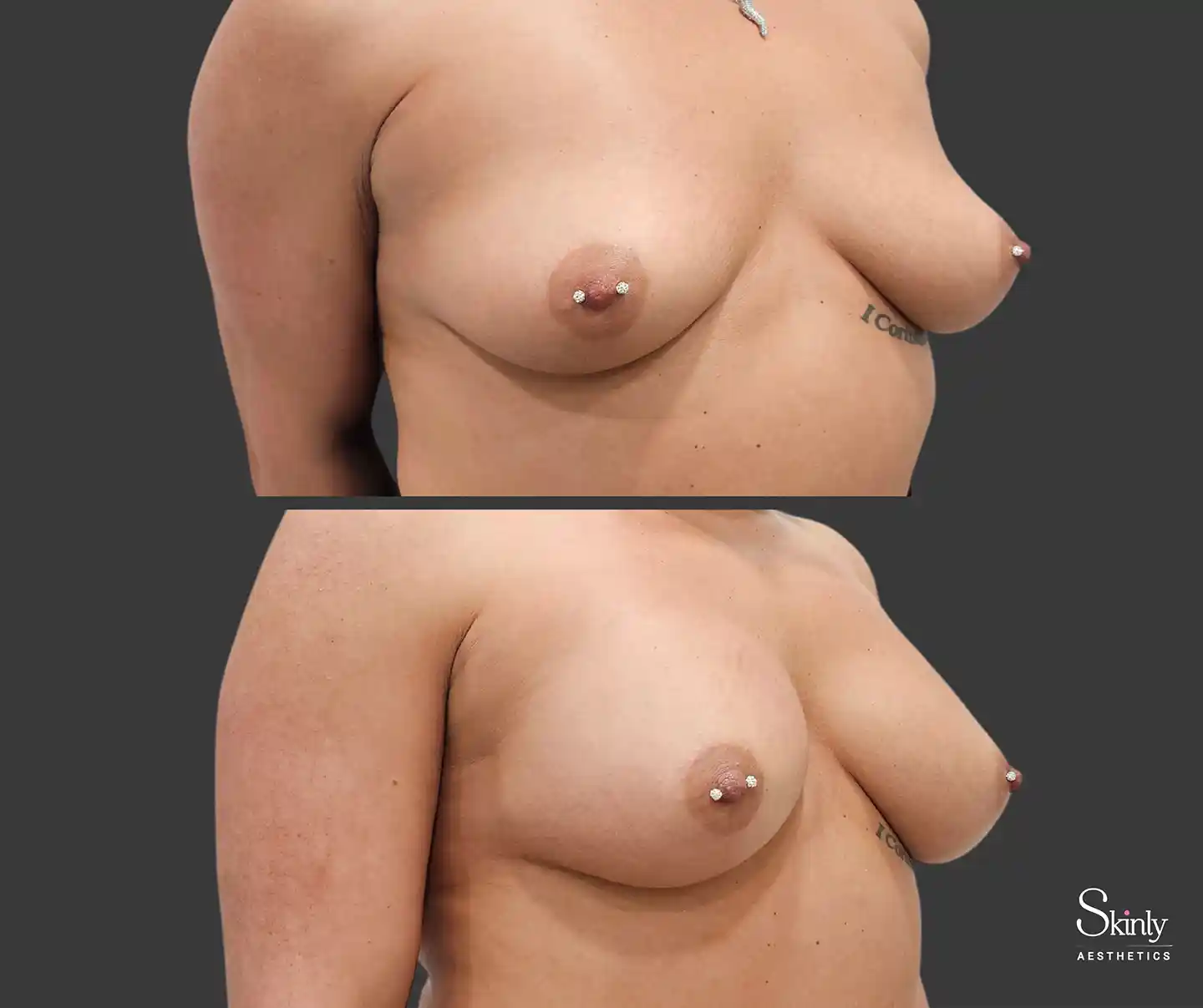 NYC patient showcasing significant breast lift and volume improvement after filler treatment