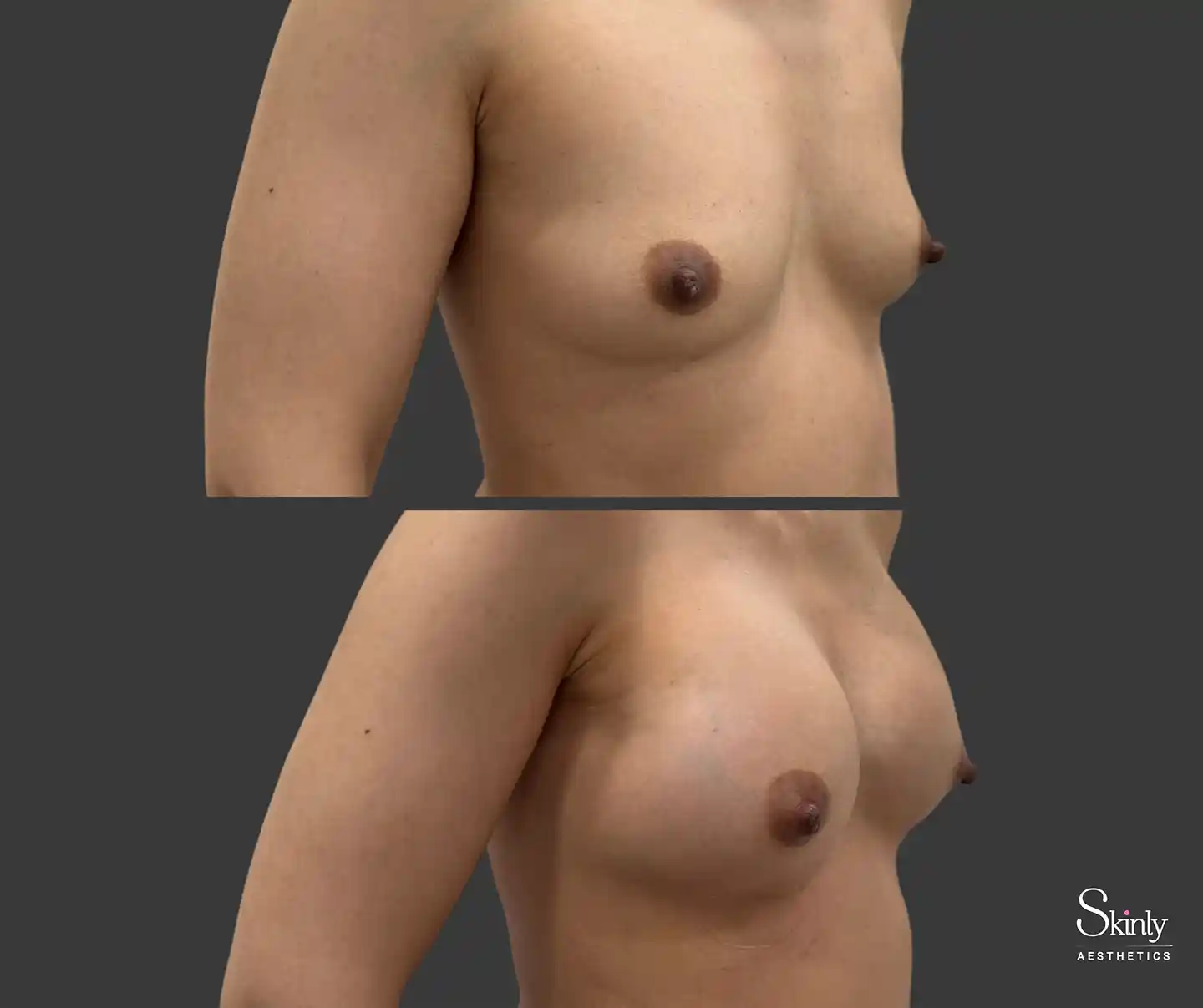 Subtle yet impactful lift seen from the side after filler treatment