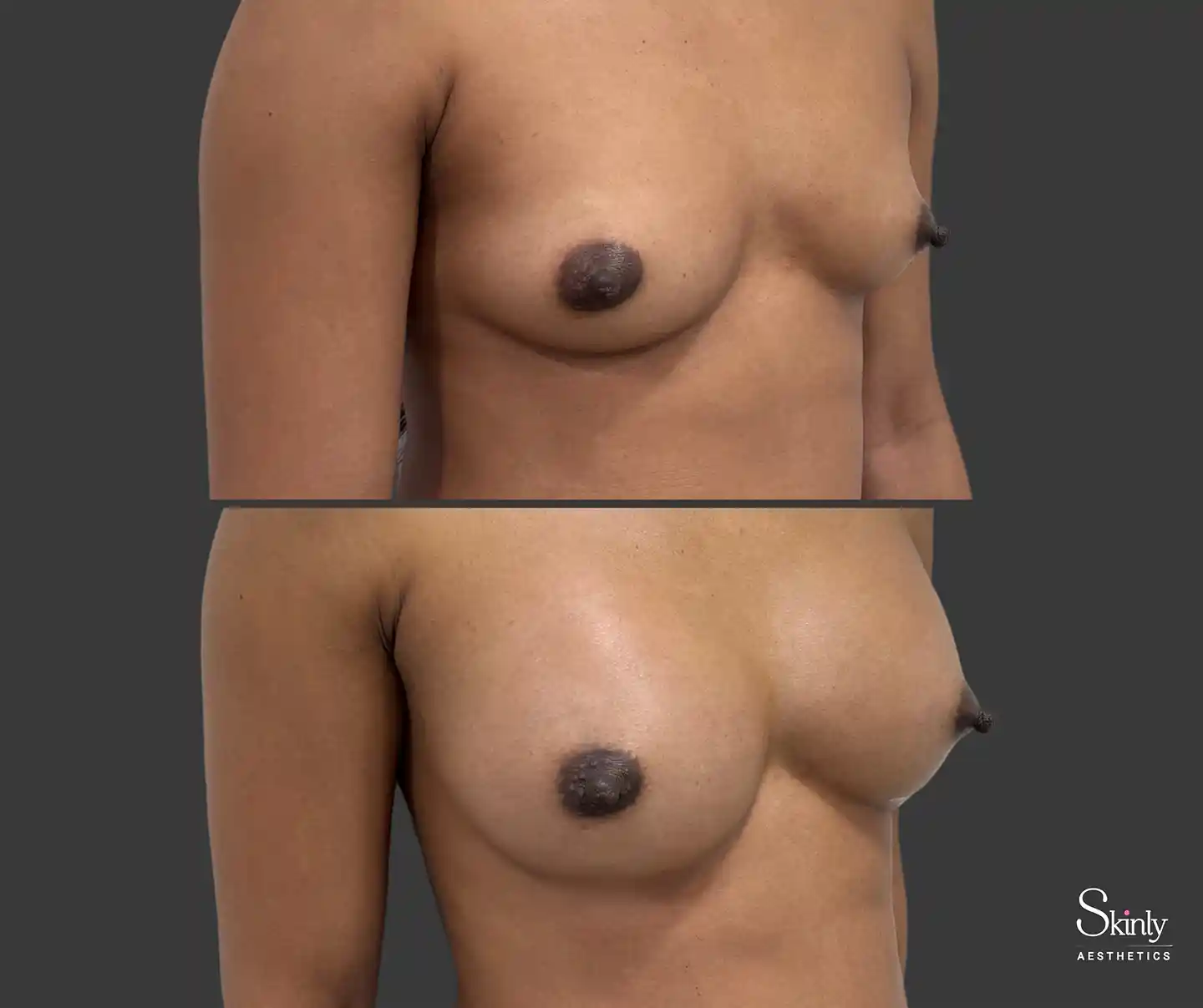 Correction of mild sagging visible from side after Liquid Breast Lift at Skinly Aesthetics