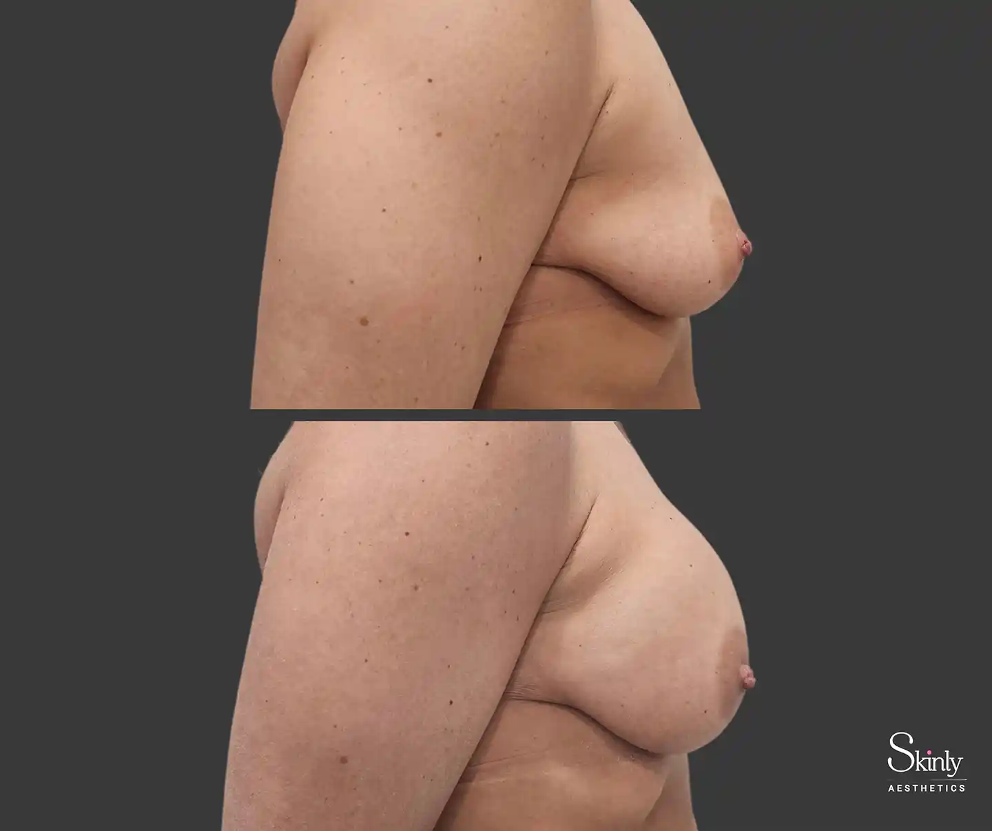 Beautiful, natural-looking breast enhancement achieved with fillers