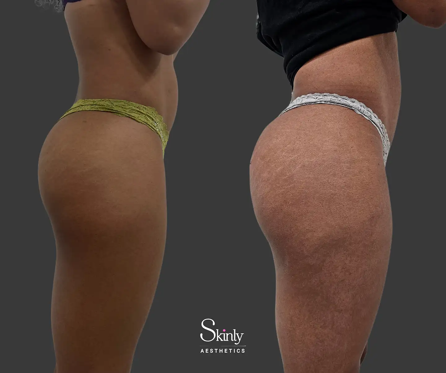 Side profile results after customized Liquid Butt Lift in NYC