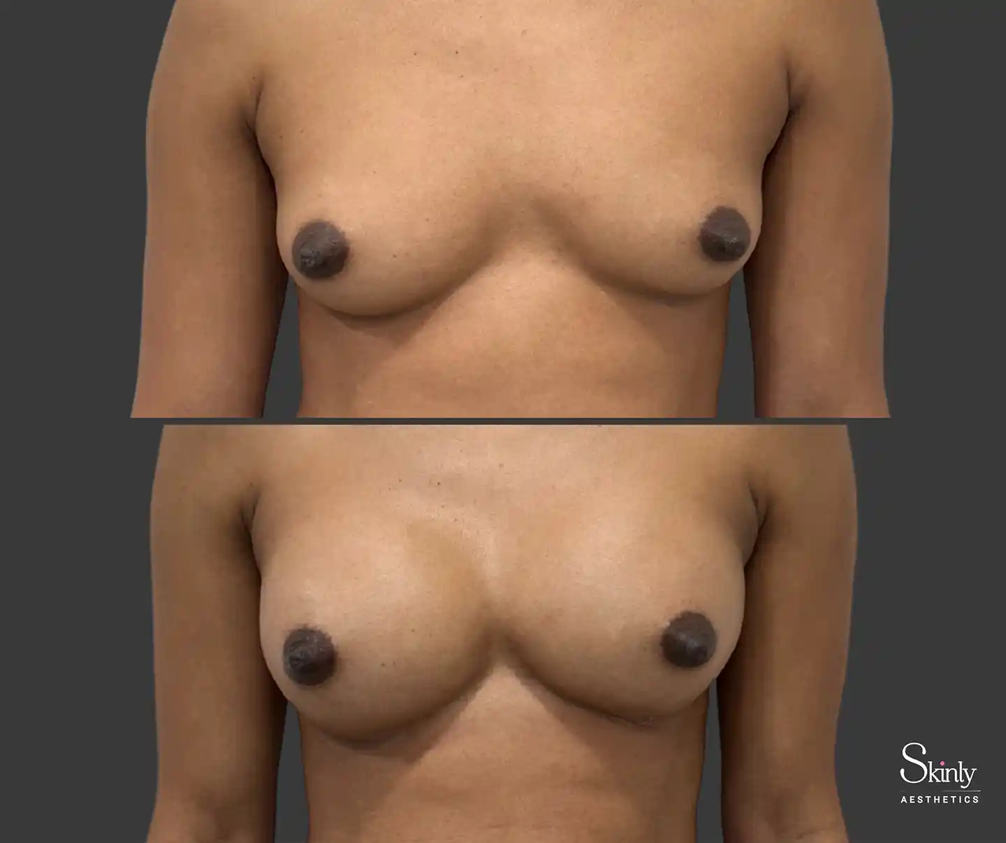 Restored breast volume clearly visible from the front after non-surgical breast enhancement