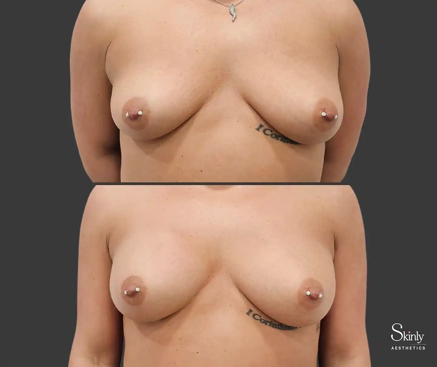 Improved breast symmetry after Liquid Breast Lift treatment by Dr. Schwarzburg
