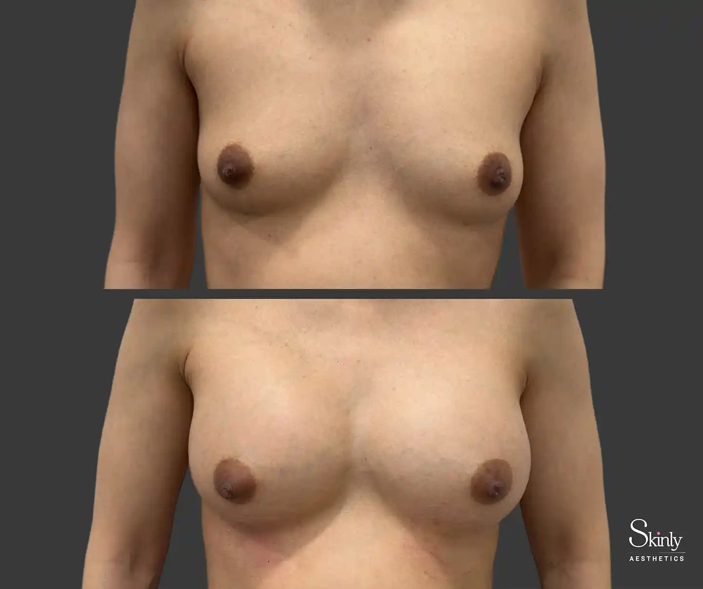 NYC patient achieves immediate breast lift and fullness, front view before-and-after